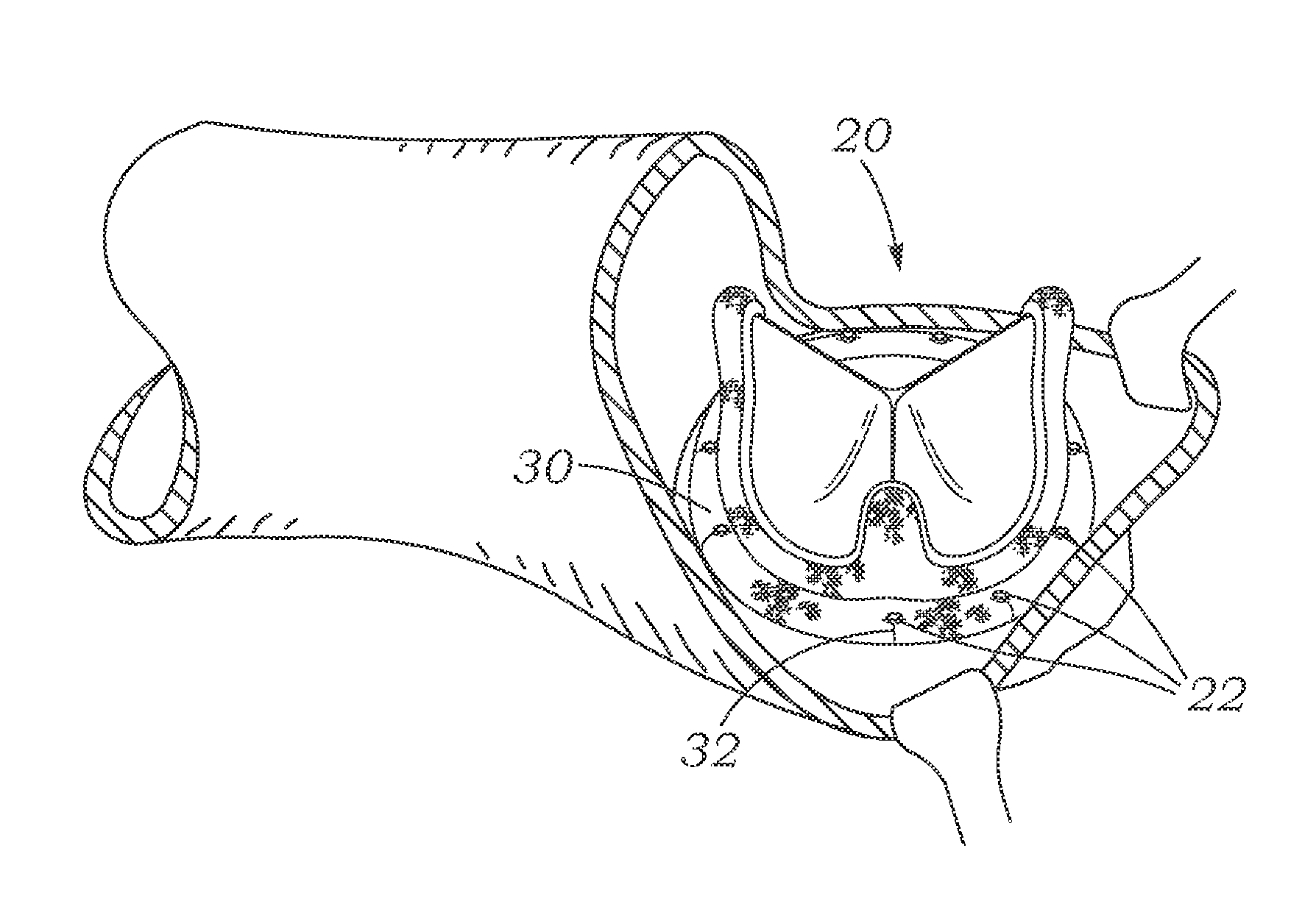 Cardiac implant with integrated suture fasteners