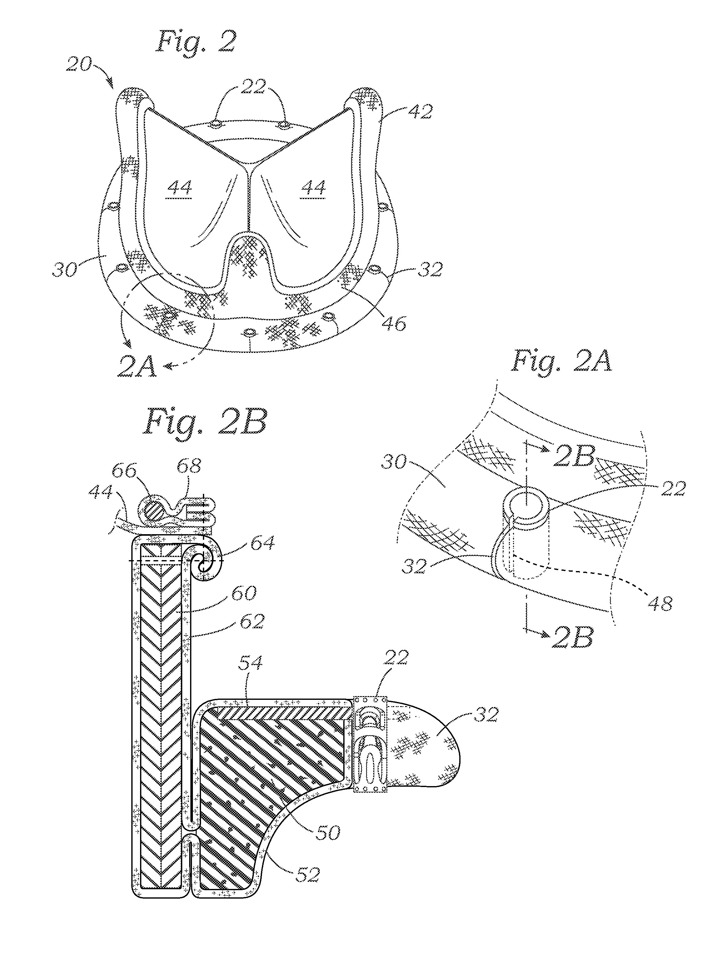 Cardiac implant with integrated suture fasteners