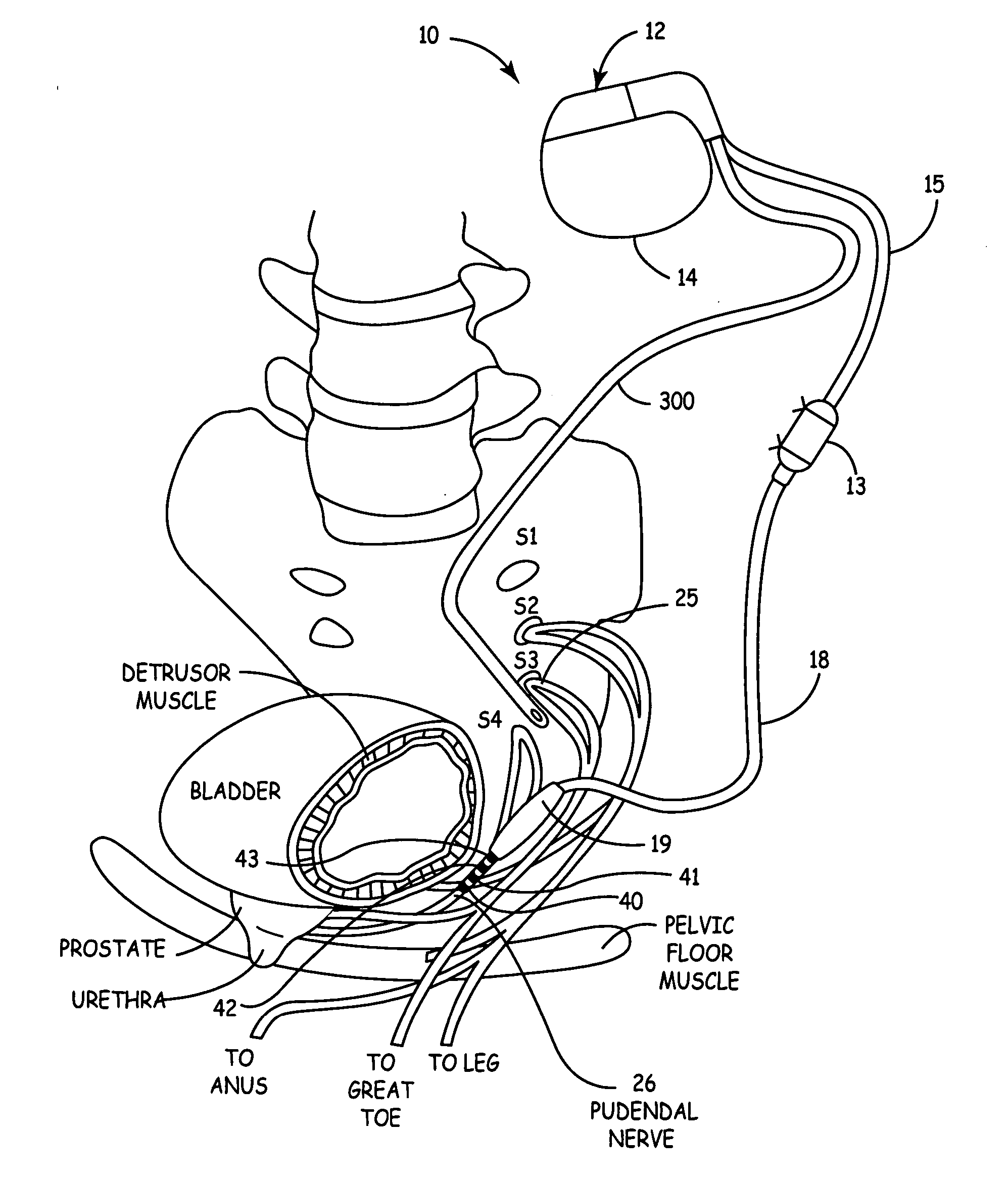 Method, system and device for treating disorders of the pelvic floor by delivering drugs to the pudendal nerves