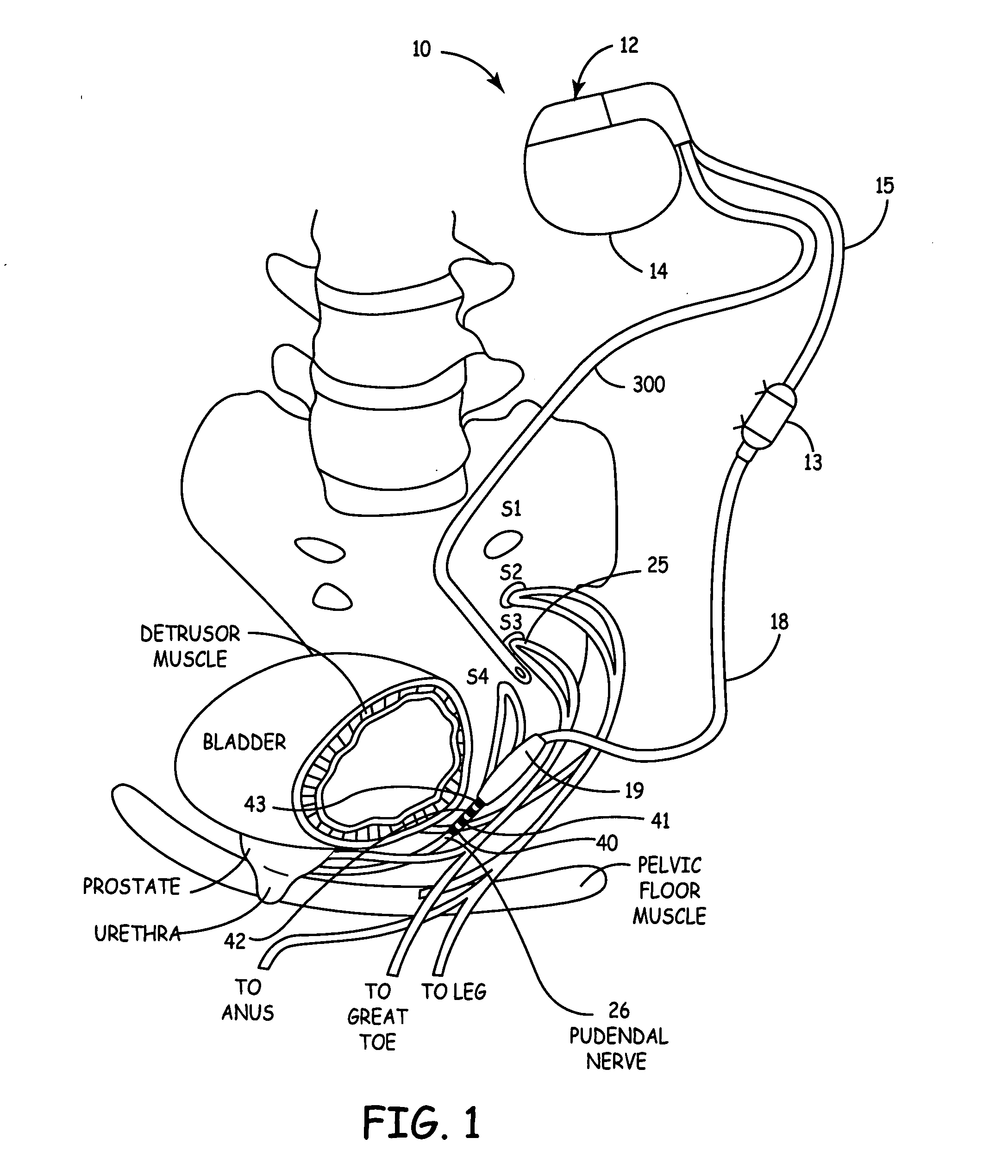 Method, system and device for treating disorders of the pelvic floor by delivering drugs to the pudendal nerves