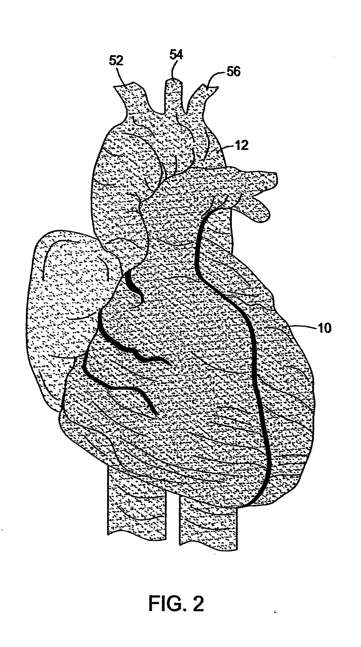 Methods and Apparatus for Treatment of Thoracic Aortic Aneurysms