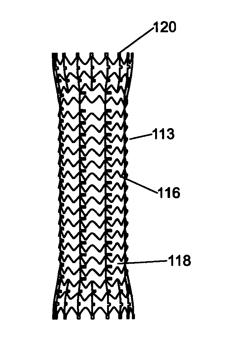 Removable stent and method of using the same