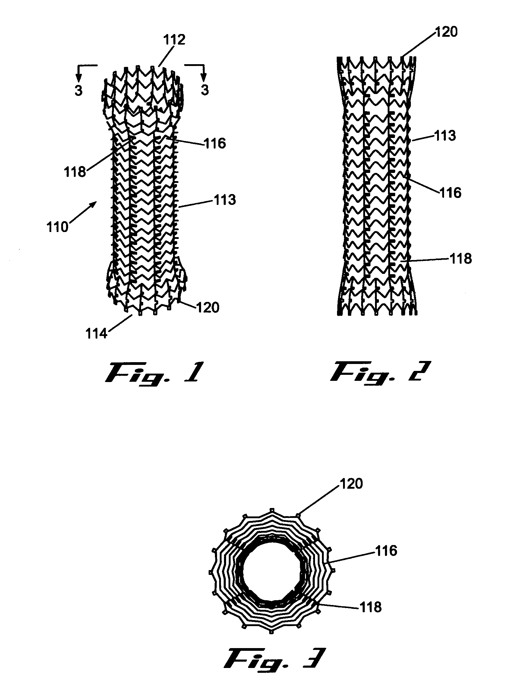 Removable stent and method of using the same