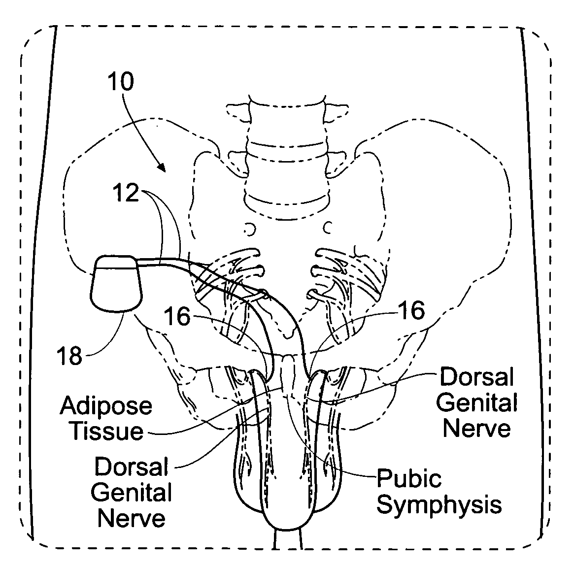 Systems for electrical stimulation of nerves in adipose tissue regions