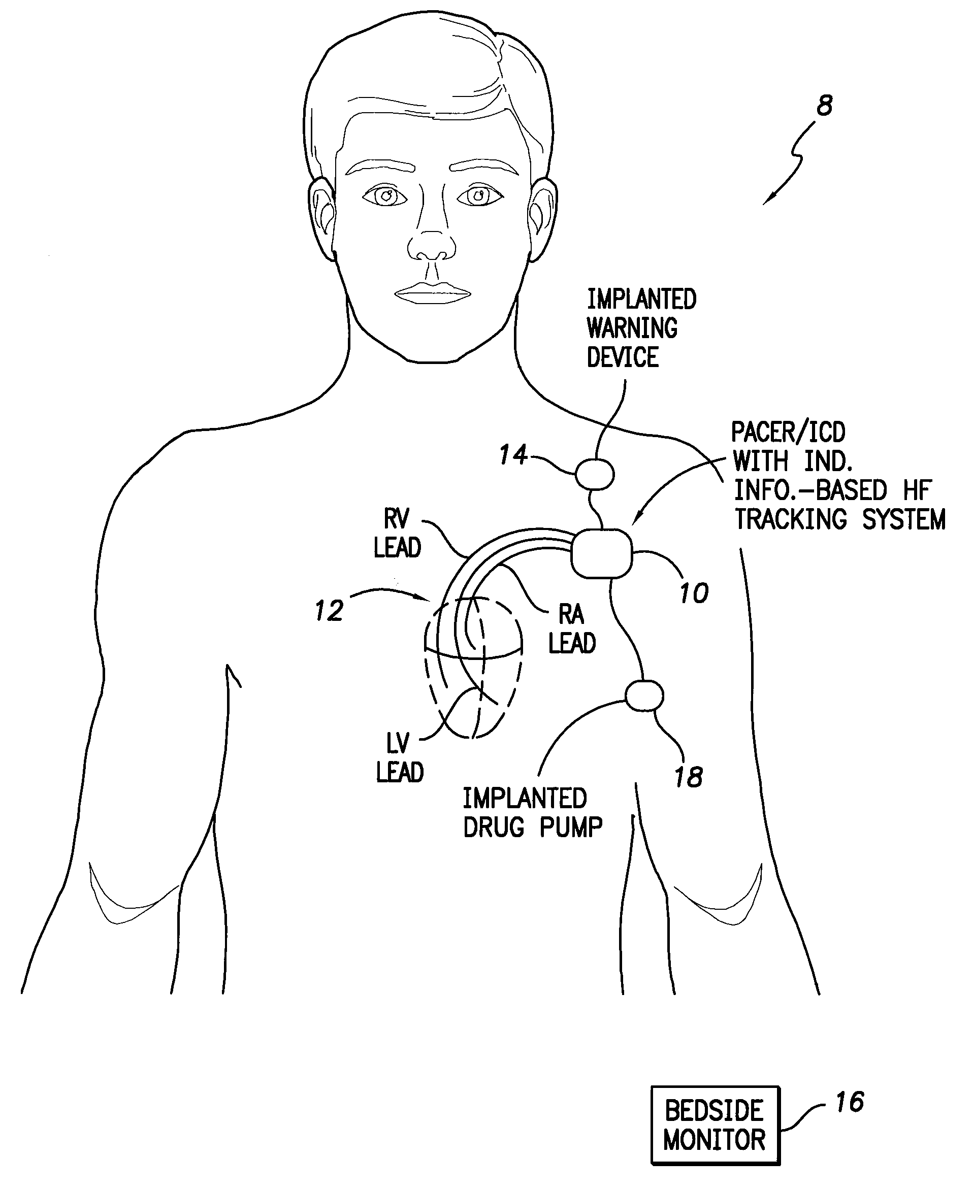 Systems and methods for use by an implantable medical device for detecting heart failure based on the independent information content of immitance vectors