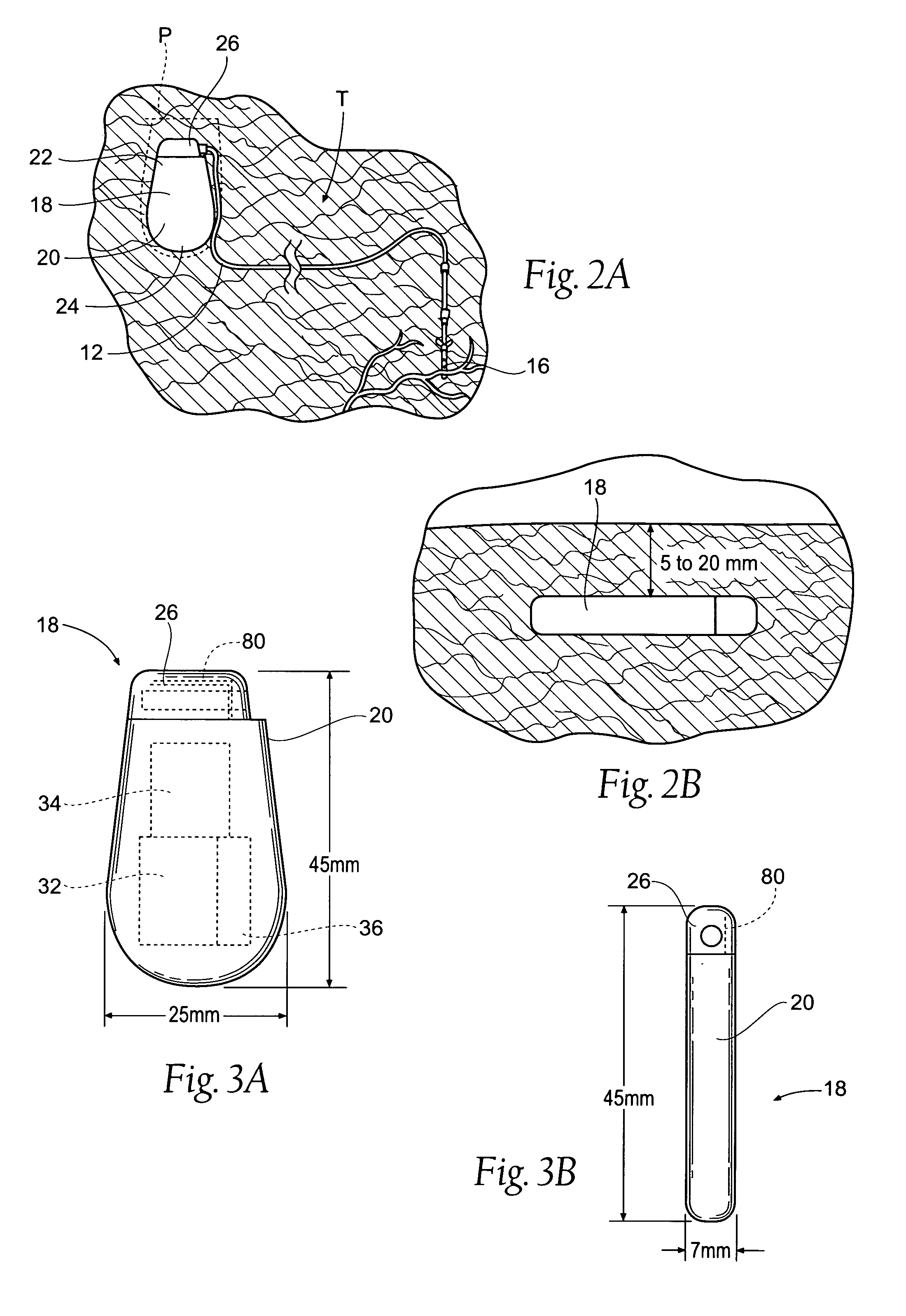 Implantable pulse generator systems and methods for providing functional and/or therapeutic stimulation of muscles and/or nerves and/or central nervous system tissue