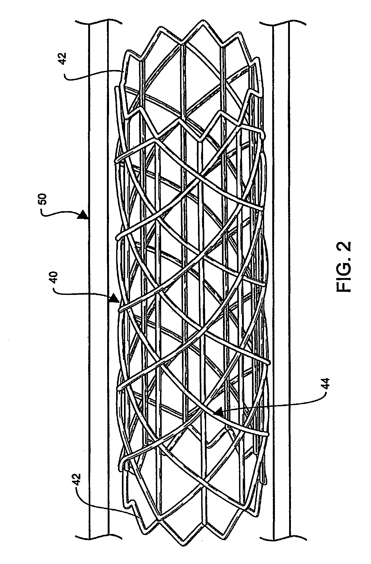 Hybrid Biodegradable/Non-Biodegradable Stent, Delivery System and Method of Treating a Vascular Condition