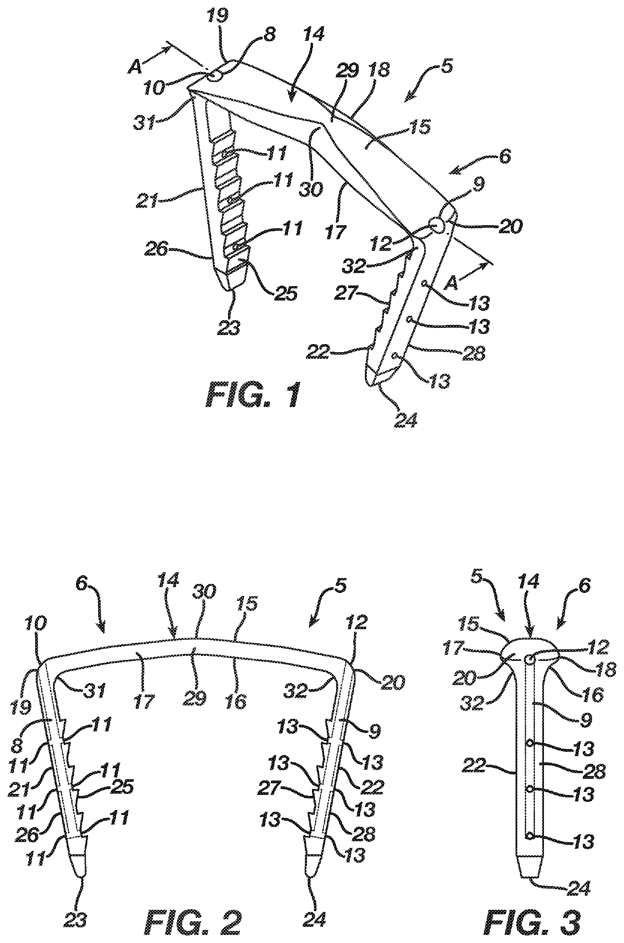 Method and apparatus for a shape memory implant