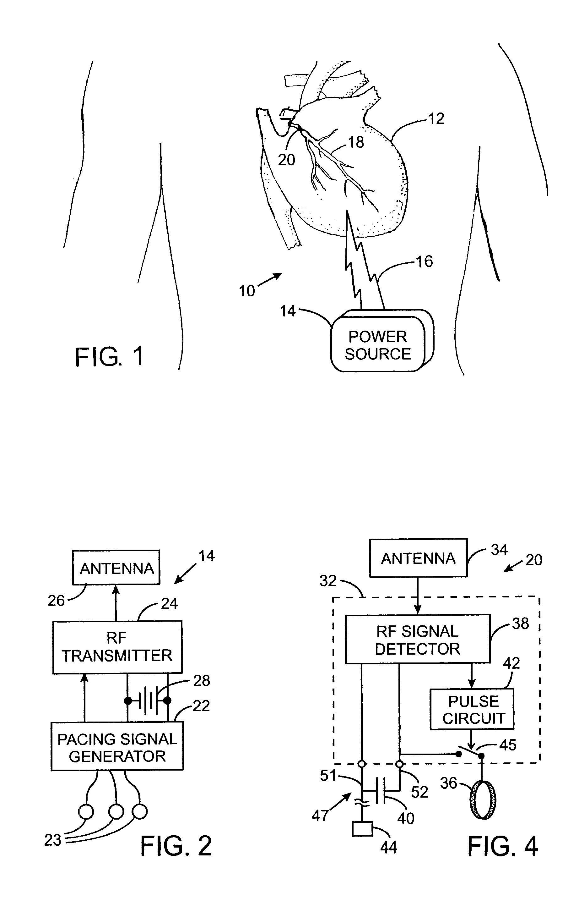 Medical Device With Intra-Conductor Capacitive Energy Storage