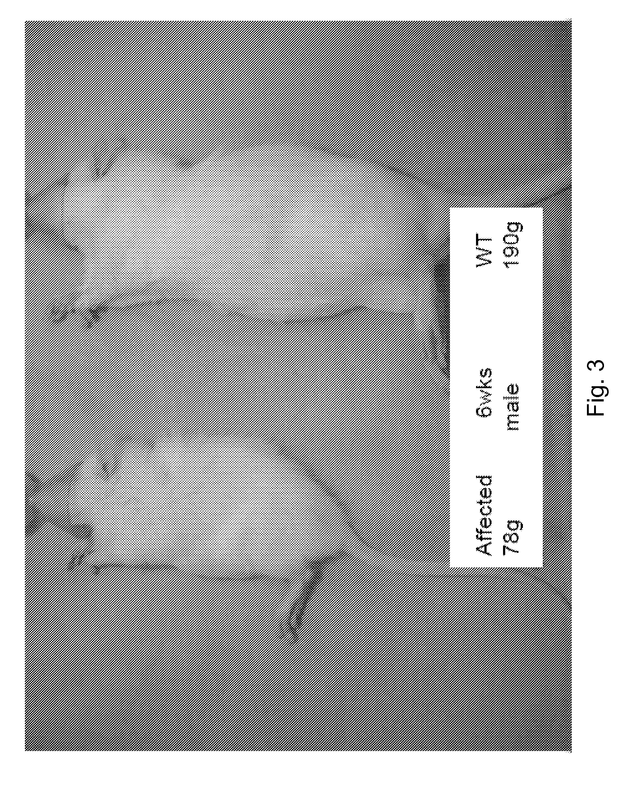 Methods for treating lysosomal acid lipase deficiency