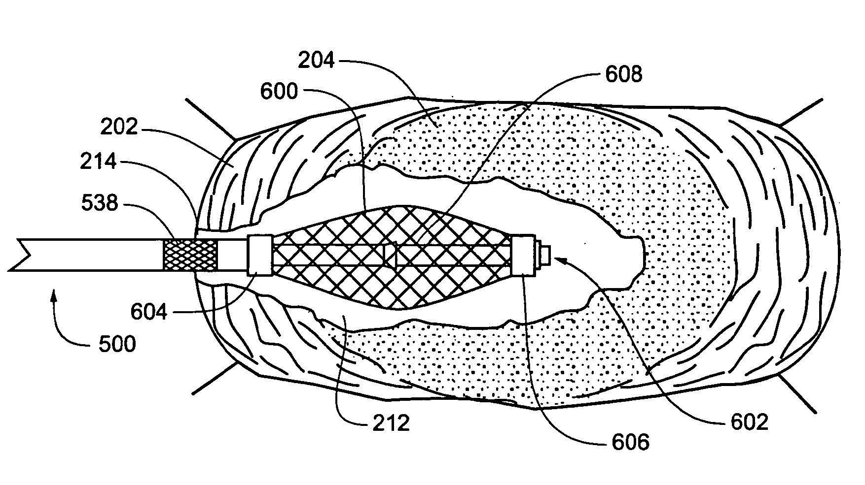 Method and Apparatus for Enhanced Delivery of Treatment Device to the Intervertebral Disc Annulus