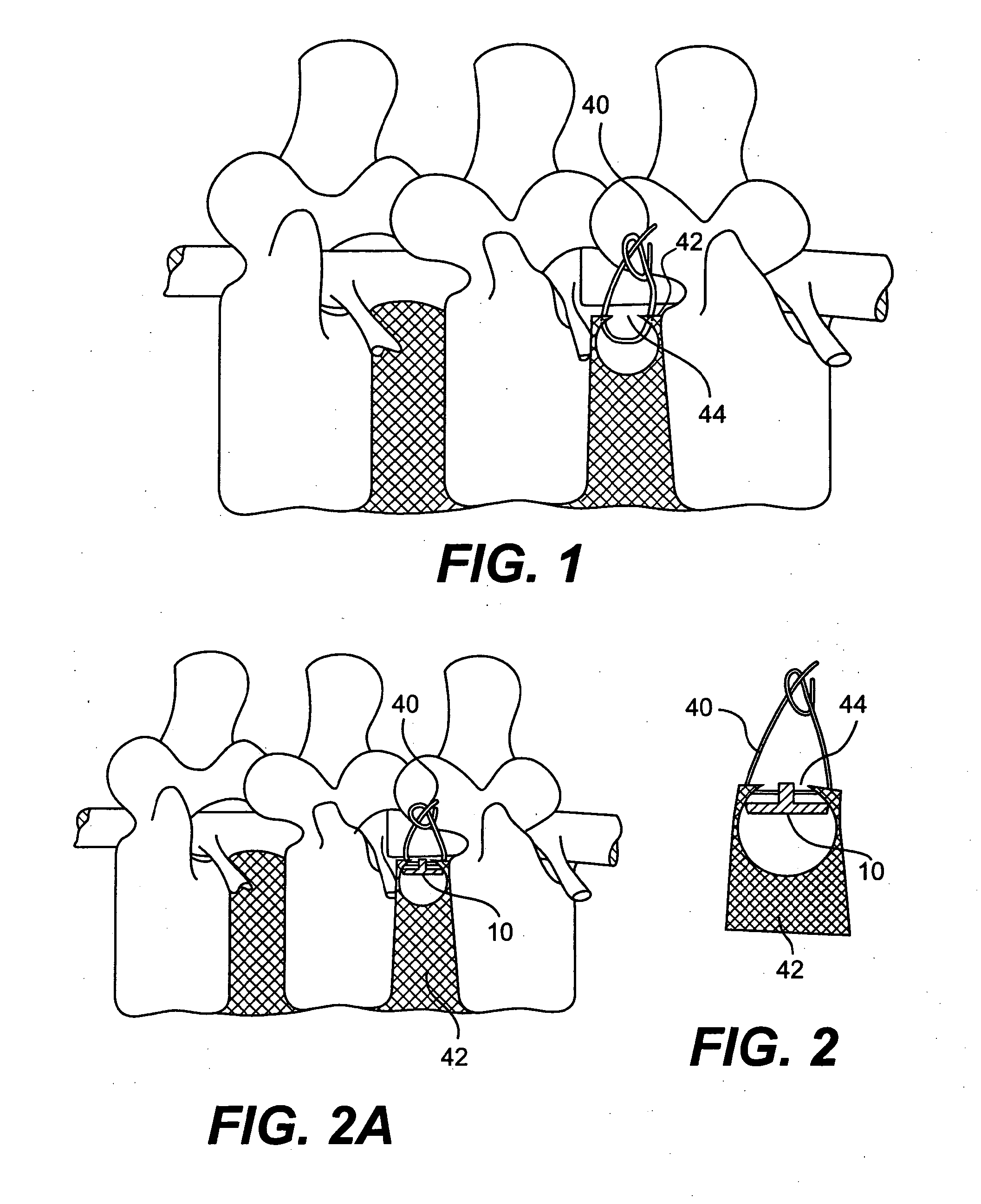 Method and Apparatus for Enhanced Delivery of Treatment Device to the Intervertebral Disc Annulus