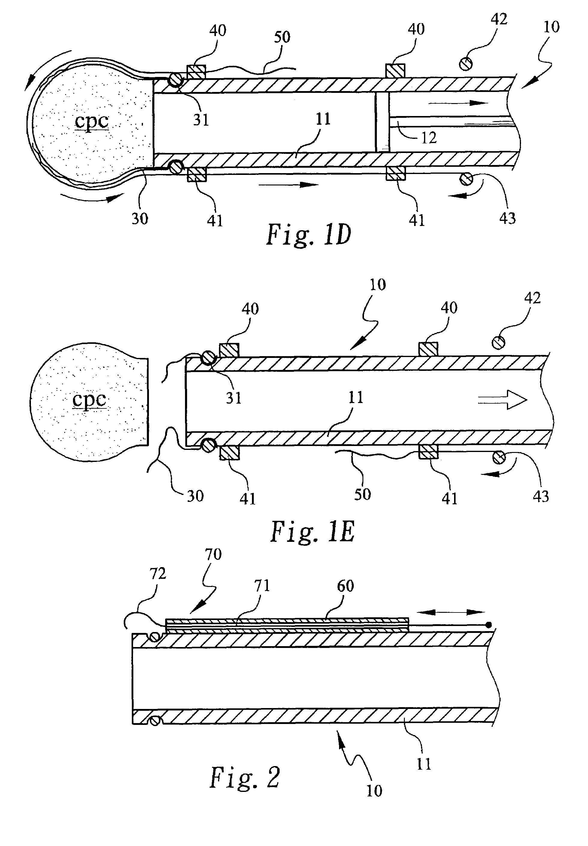 Method and device for forming a hardened cement in a bone cavity
