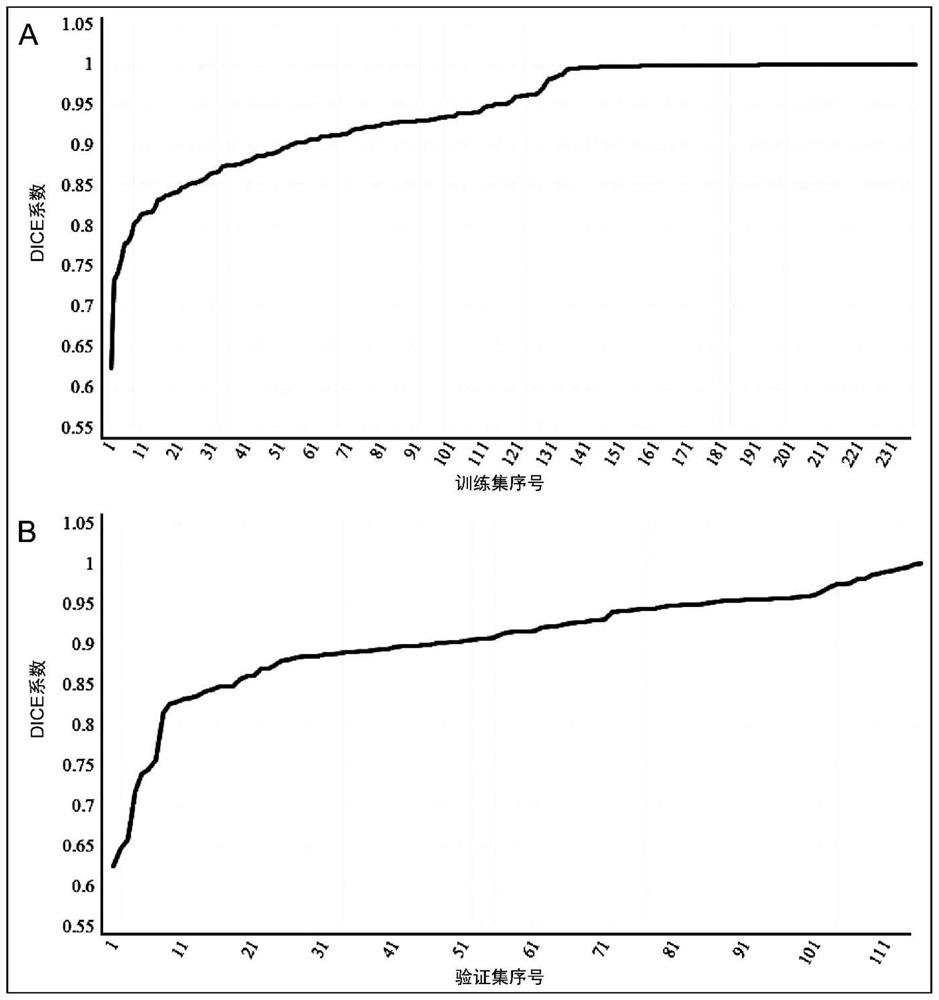 Method for automatically segmenting chest anterior mediastinal focus based on CT image