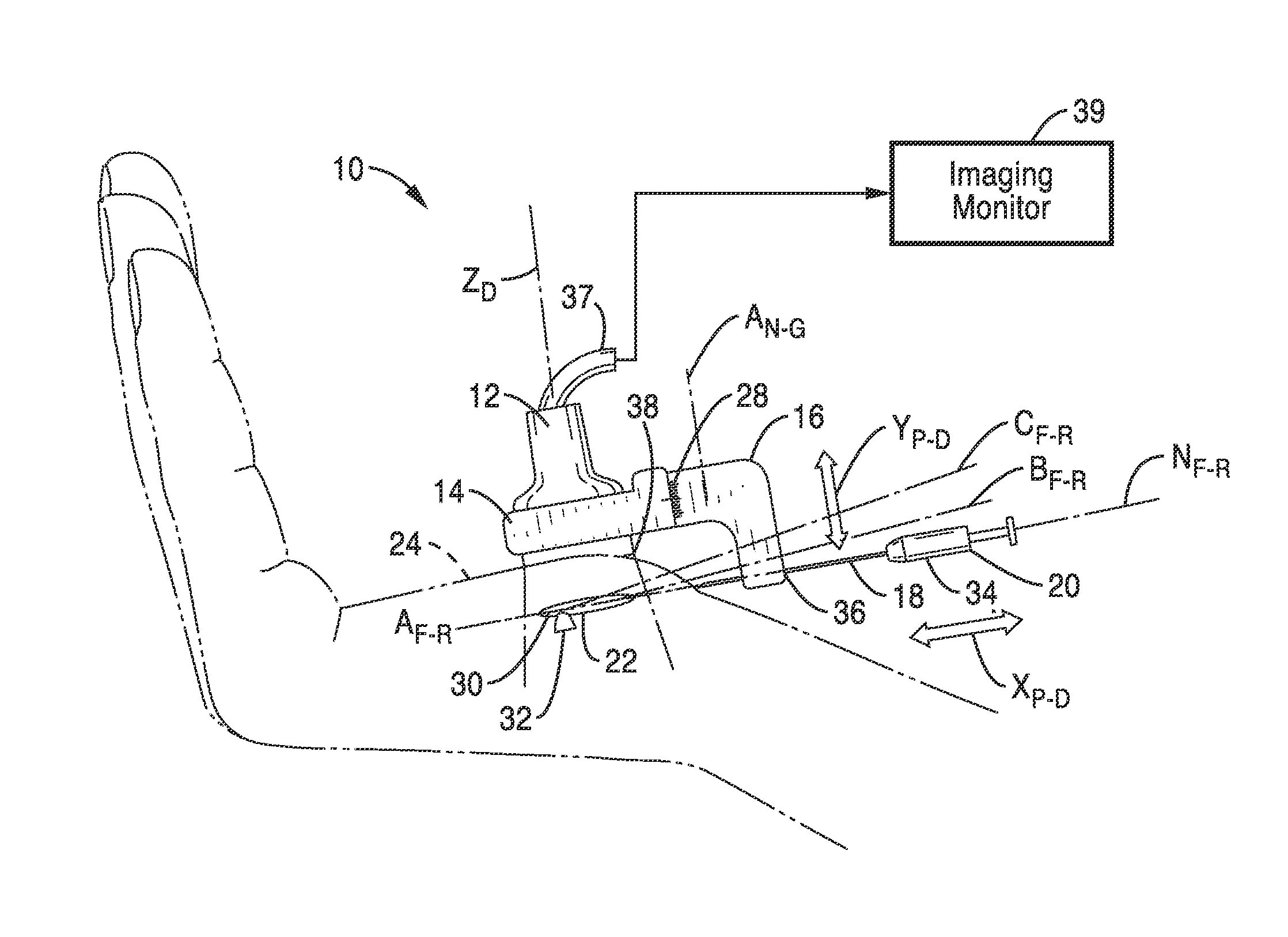 Treatment of carpal tunnel syndrome by injection of the flexor retinaculum