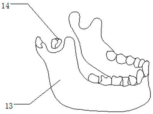 Novel forceps for reduction of sagittal fracture of mandibular condyle and production method of jaws of novel forceps