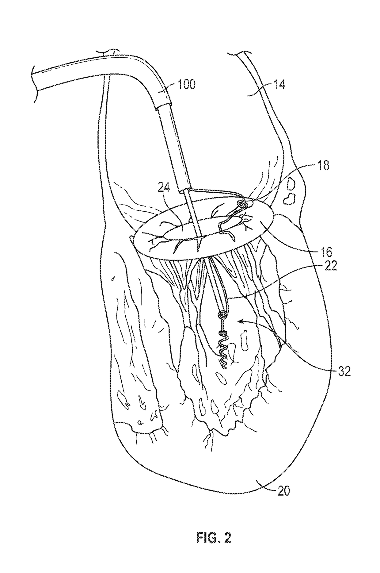 Method and apparatus for transvascular implantation of neo chordae tendinae
