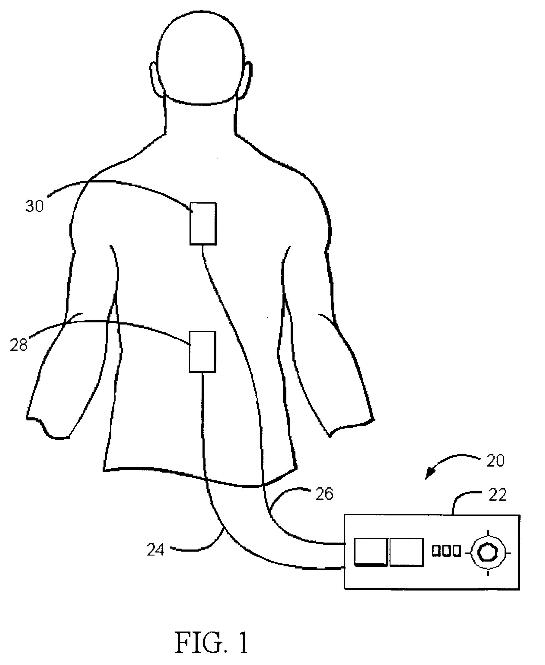Transcutaneous electrical nerve stimulator for appetite control