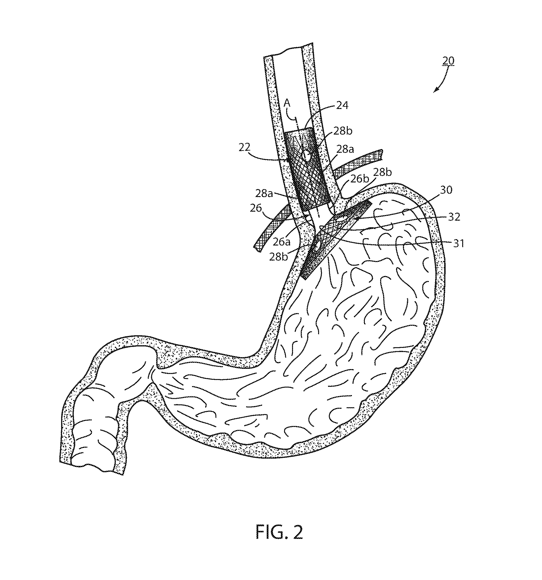 Method and device for treating metabolic disease