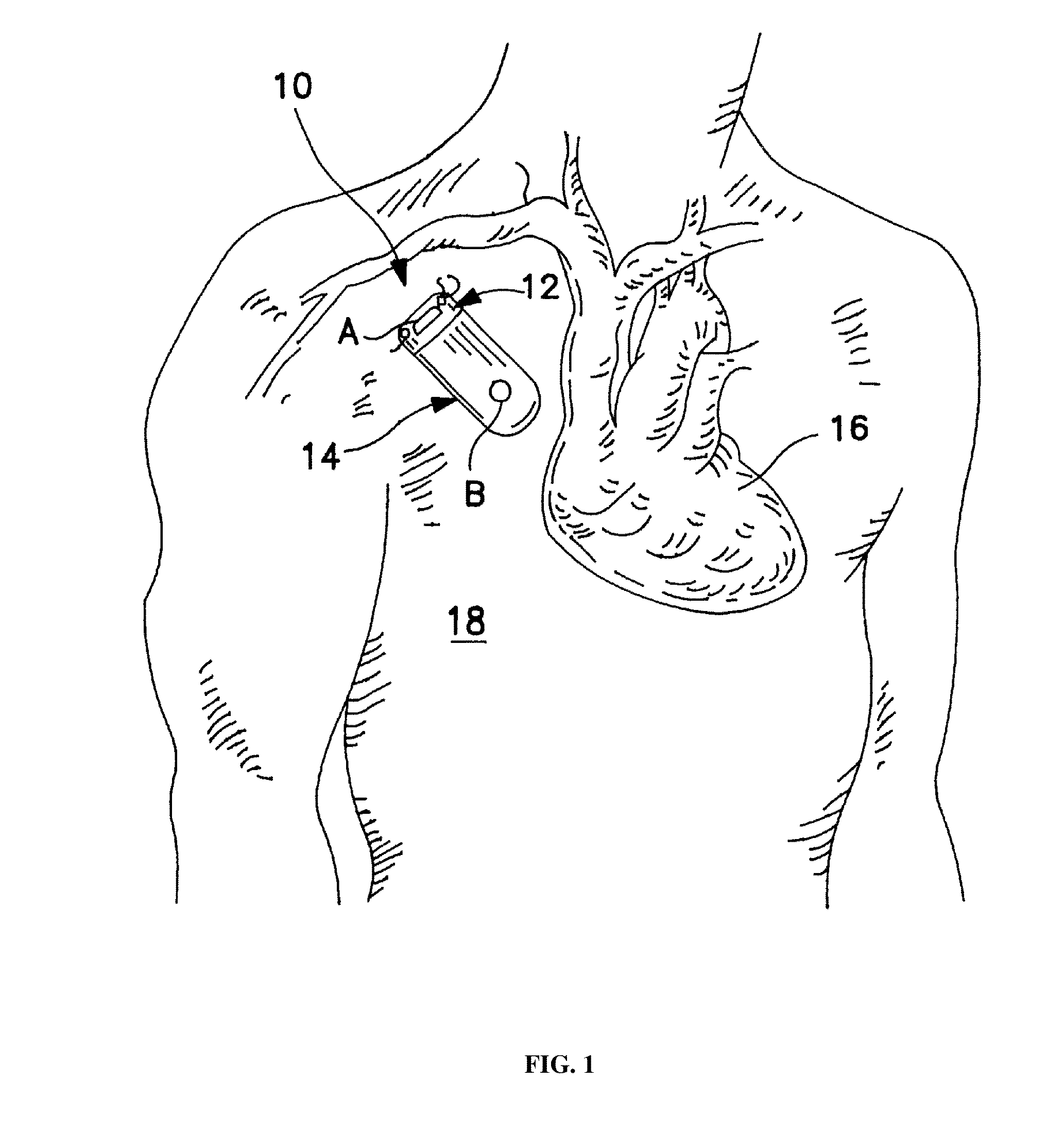 Method and device to monitor patients with kidney disease