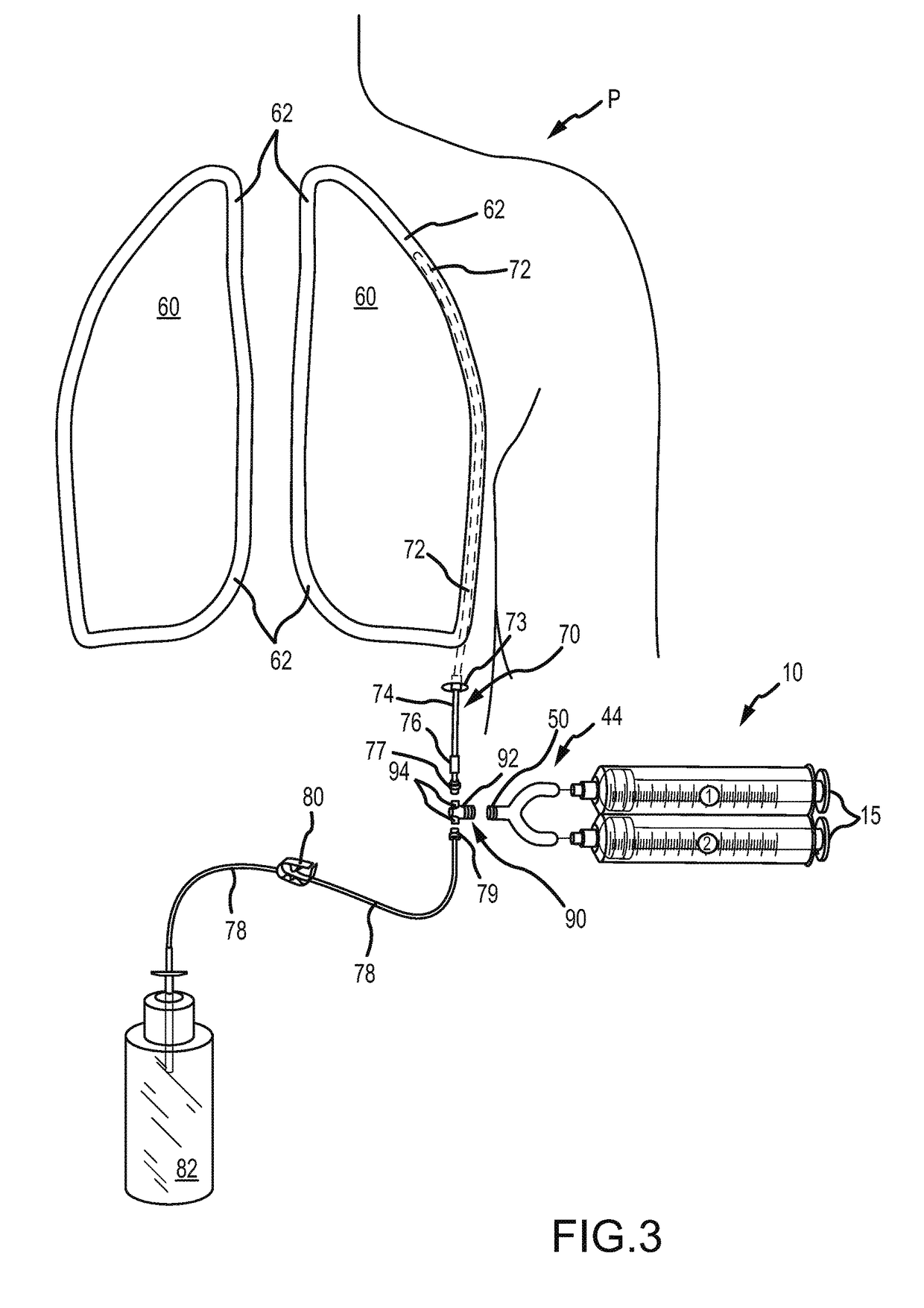Device and method to facilitate pleurodesis for management of fluid drainage