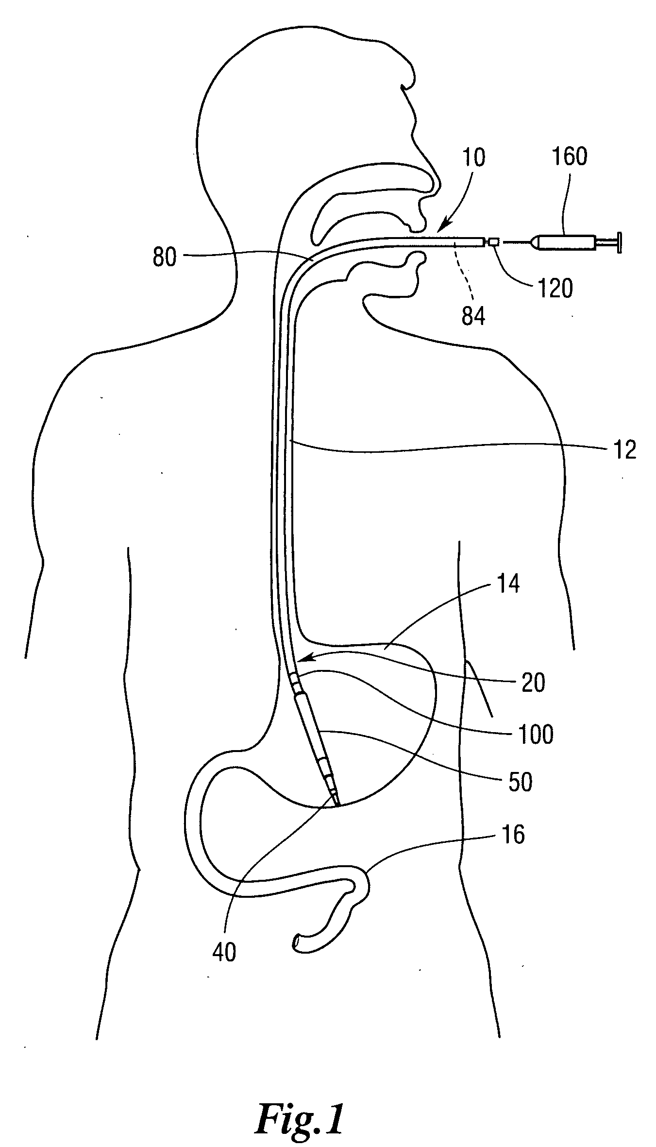 Surgical devices and methods using magnetic force to form an anastomosis