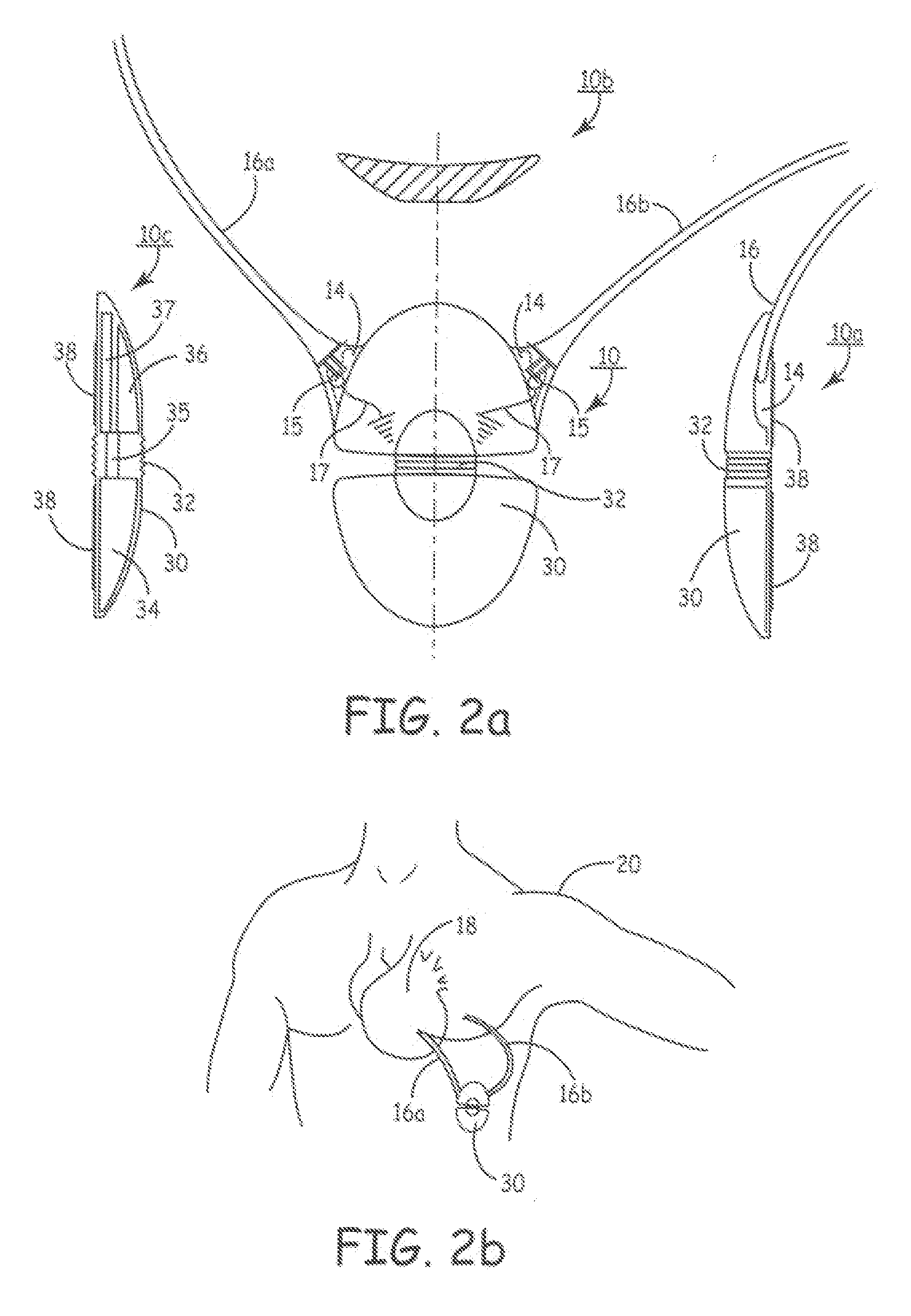 Methods and Apparatus for Selectively Shunting Energy in an Implantable Extra-Cardiac Defibrillation Device