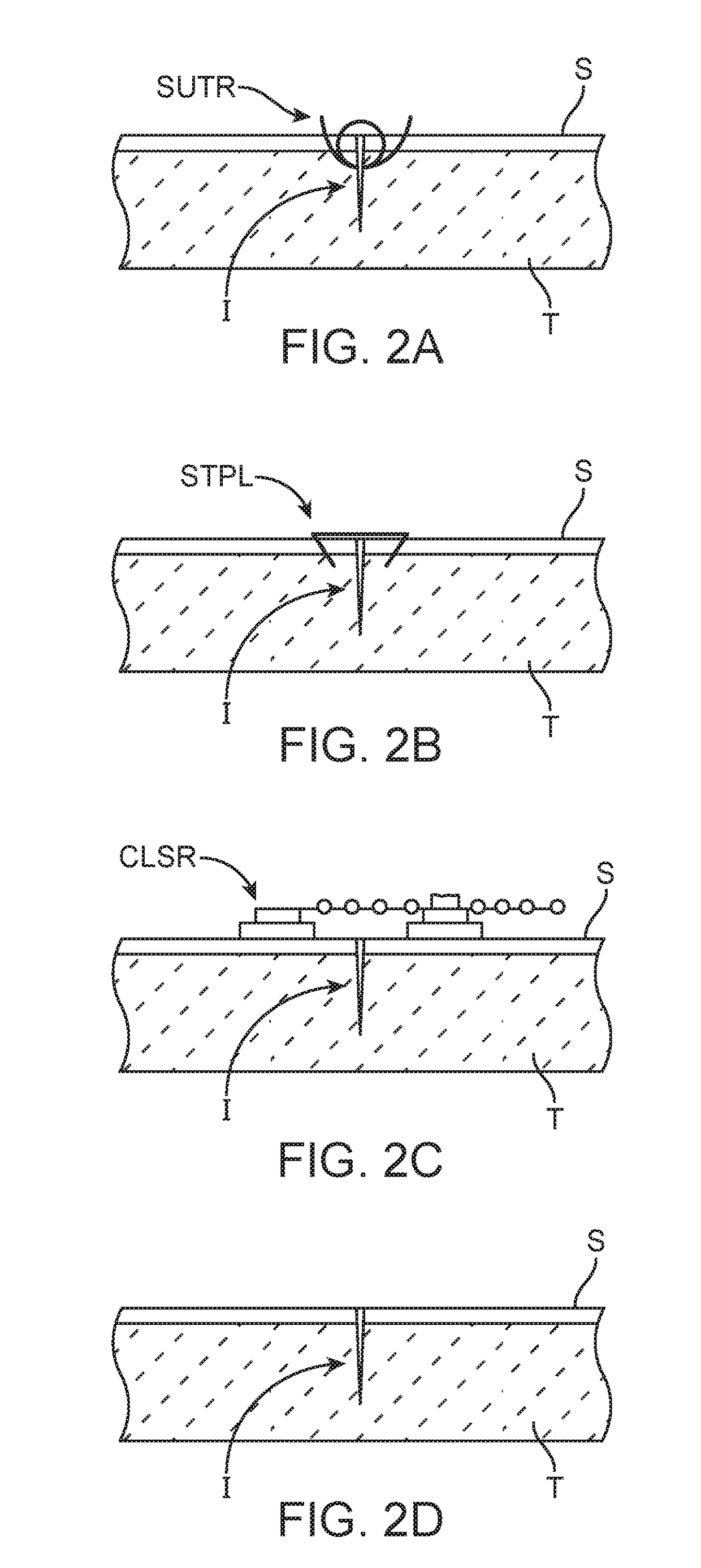Devices and methods for inhibiting scar formation in a healing wound or incision