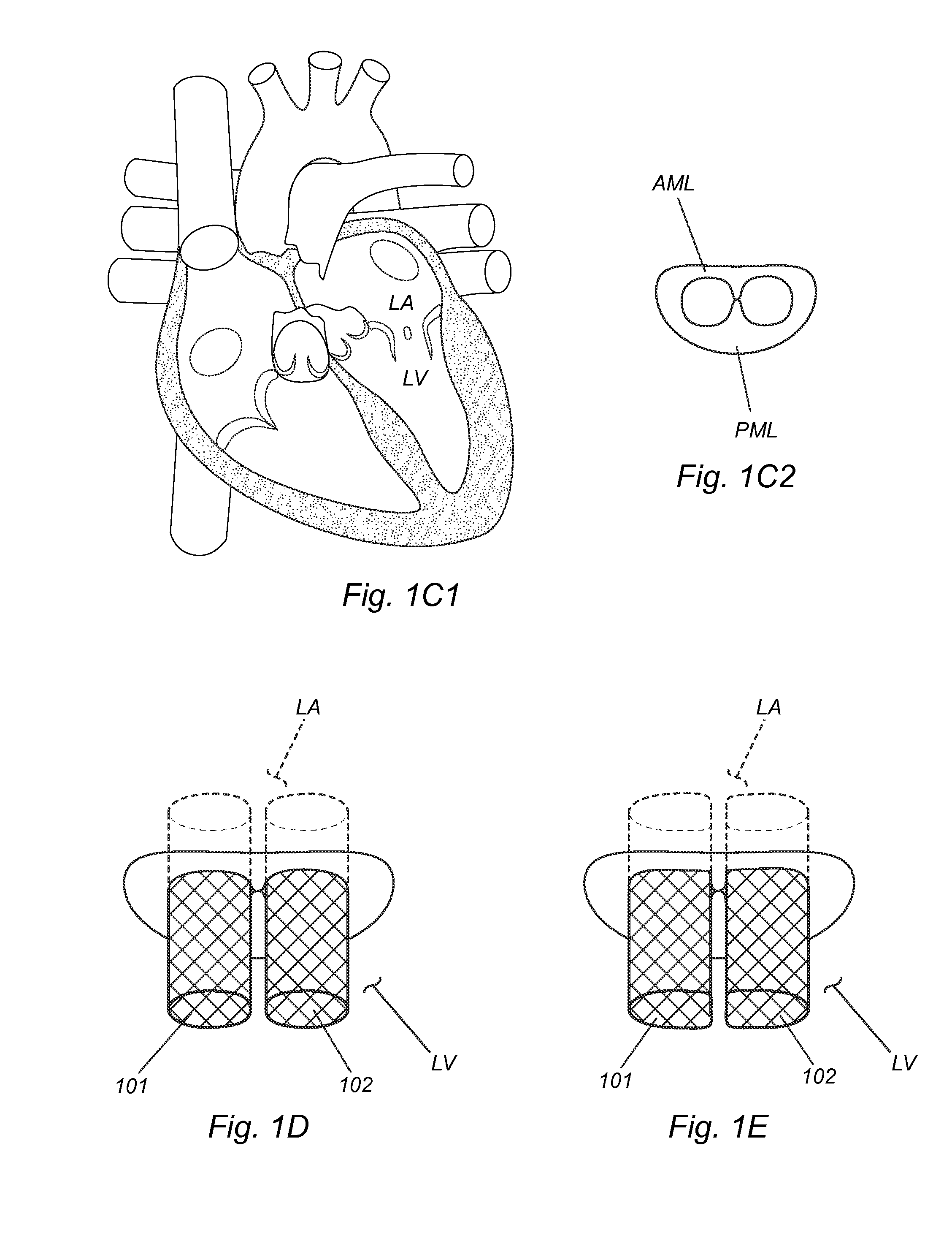 Methods, devices and systems for transcatheter mitral valve replacement in a double-orifice mitral valve