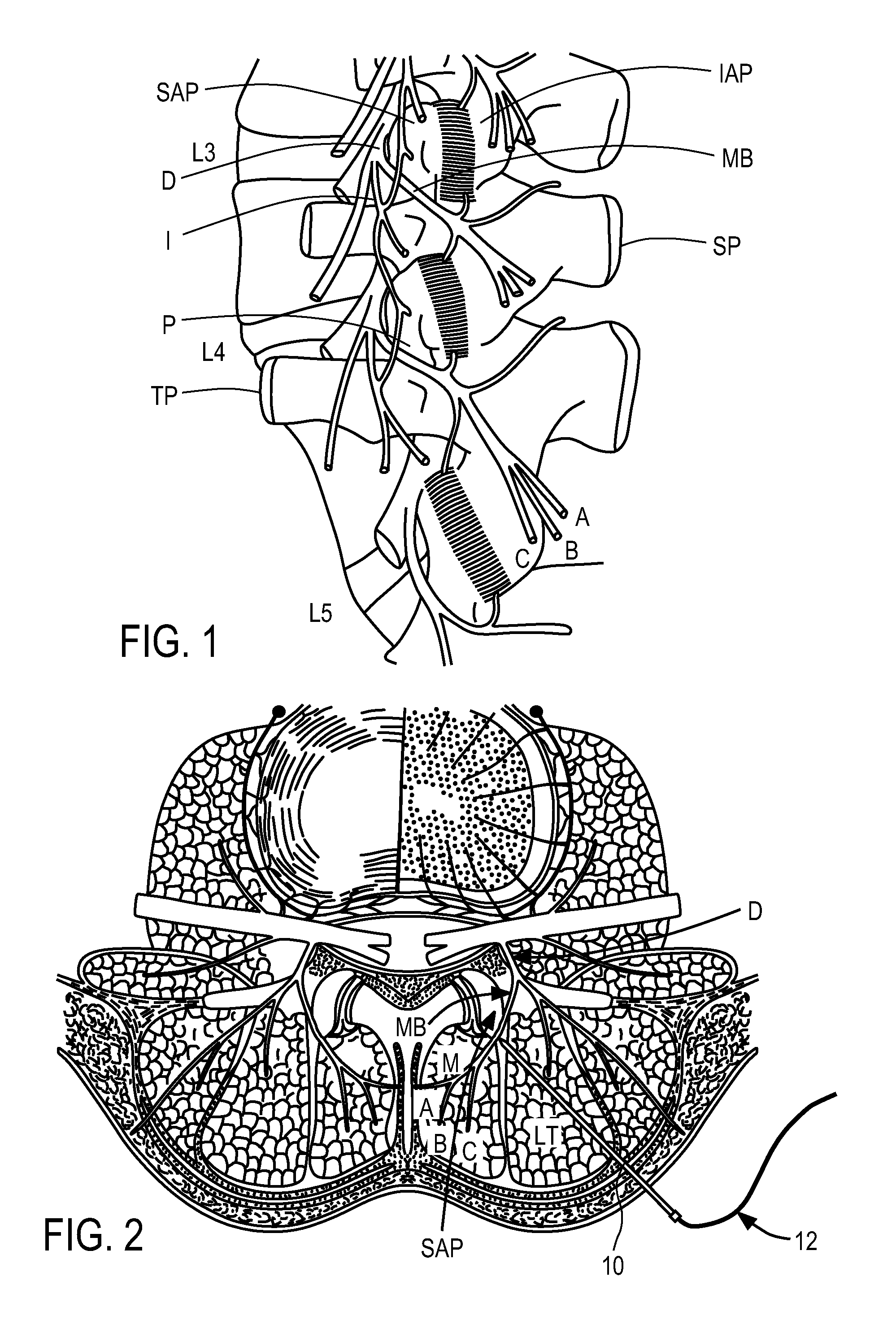 Methods of implanting electrode leads for use with implantable neuromuscular electrical stimulator