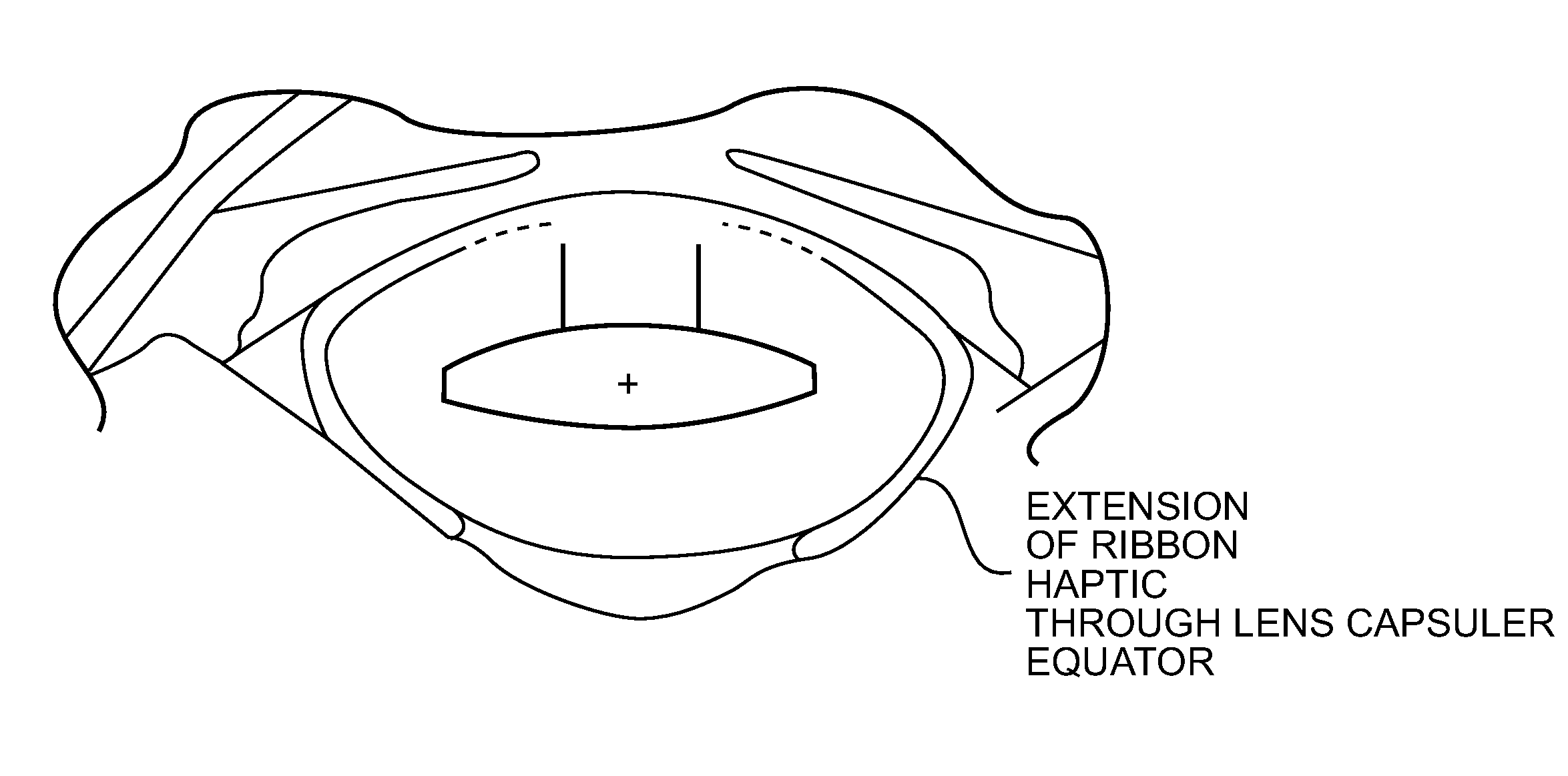 Pseudophakic Accommodating Intraocular Lens