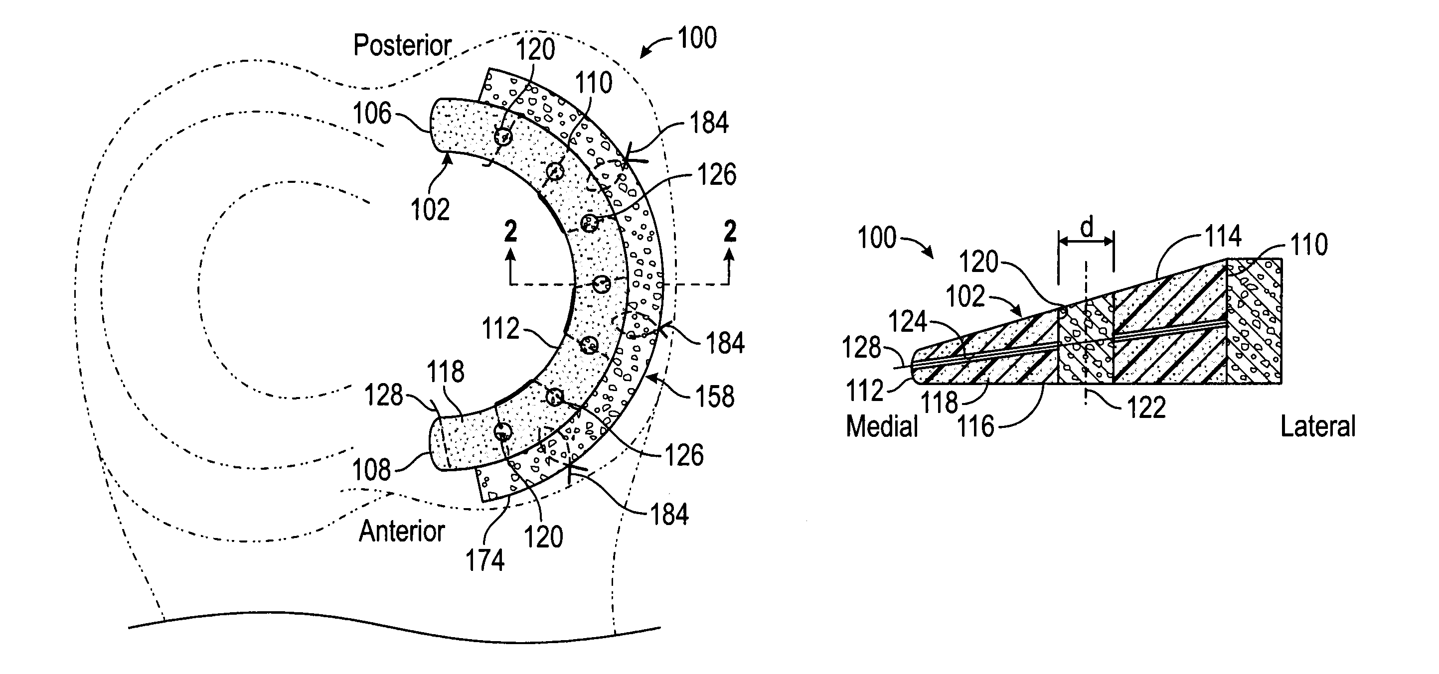 Method and implant for replacing damaged meniscal tissue