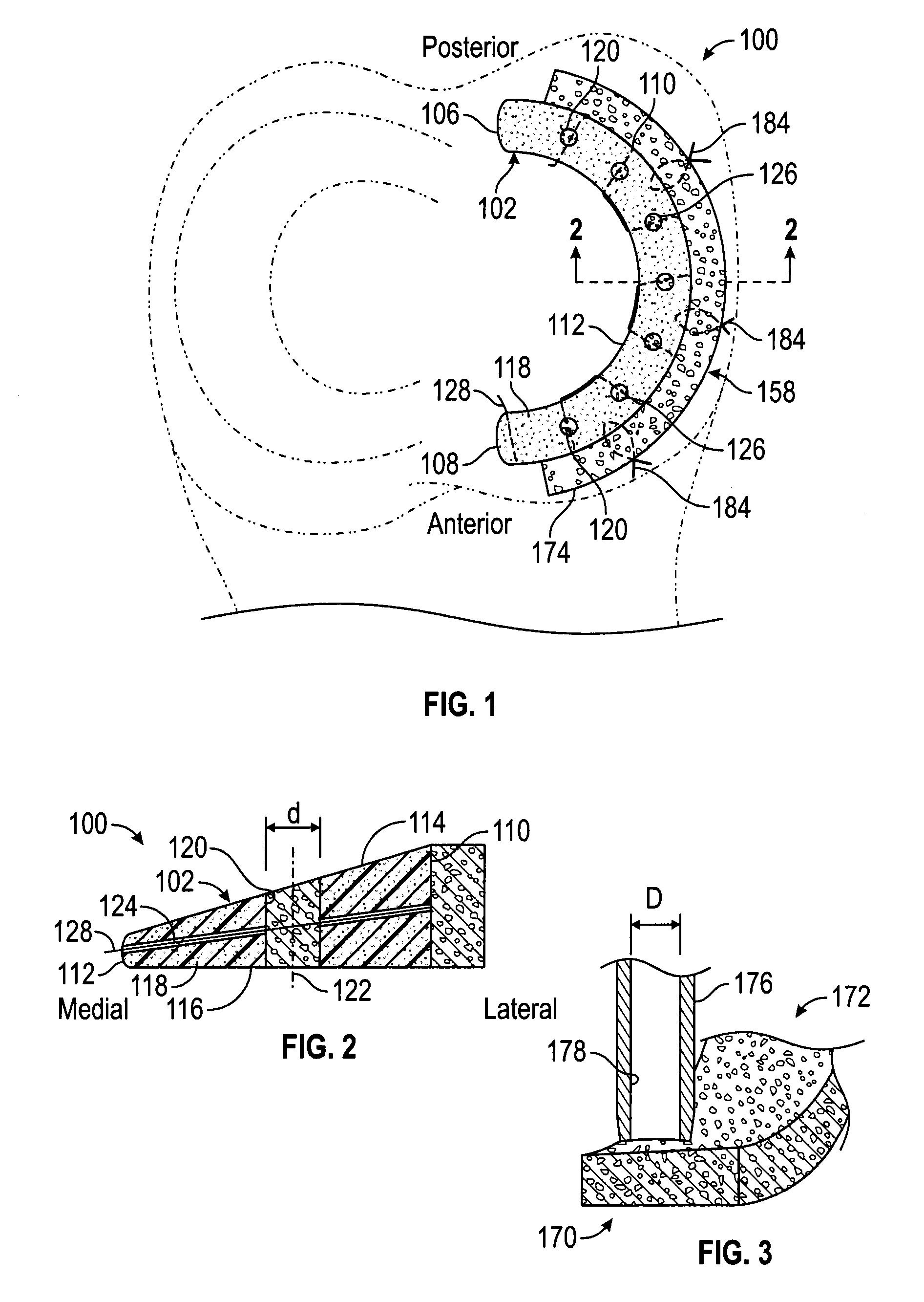Method and implant for replacing damaged meniscal tissue