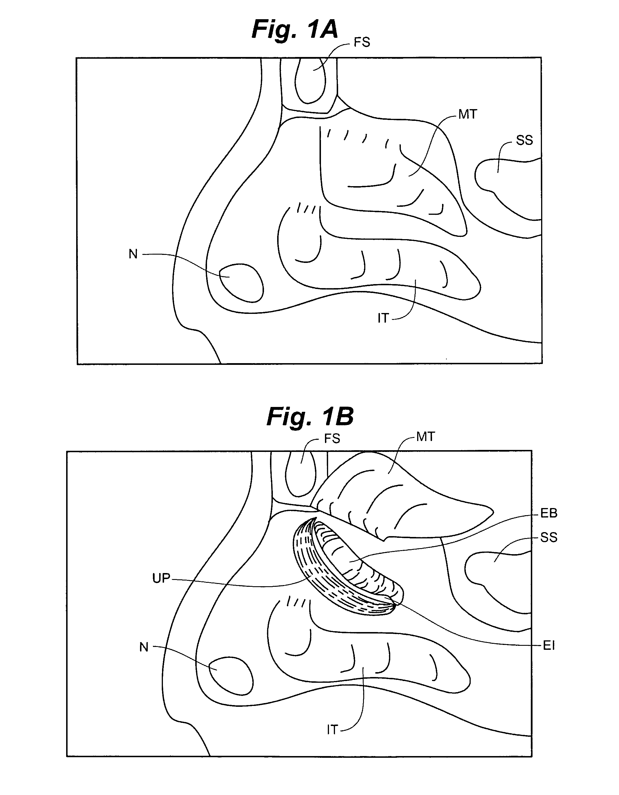 Devices and methods for minimally invasive access to sinuses and treatment of sinusitis