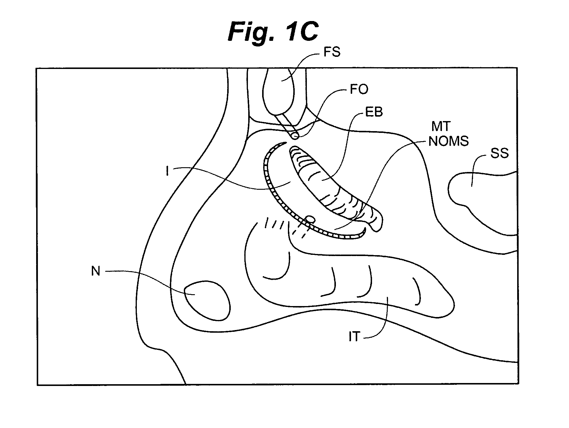 Devices and methods for minimally invasive access to sinuses and treatment of sinusitis