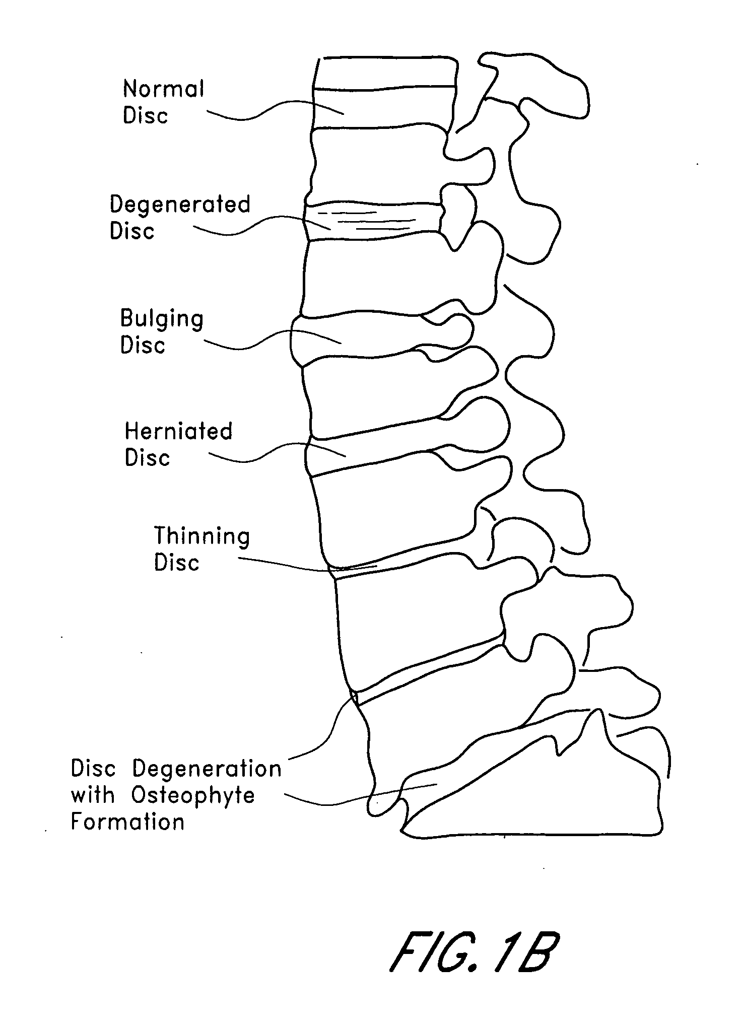 Method and apparatus for spinal distraction
