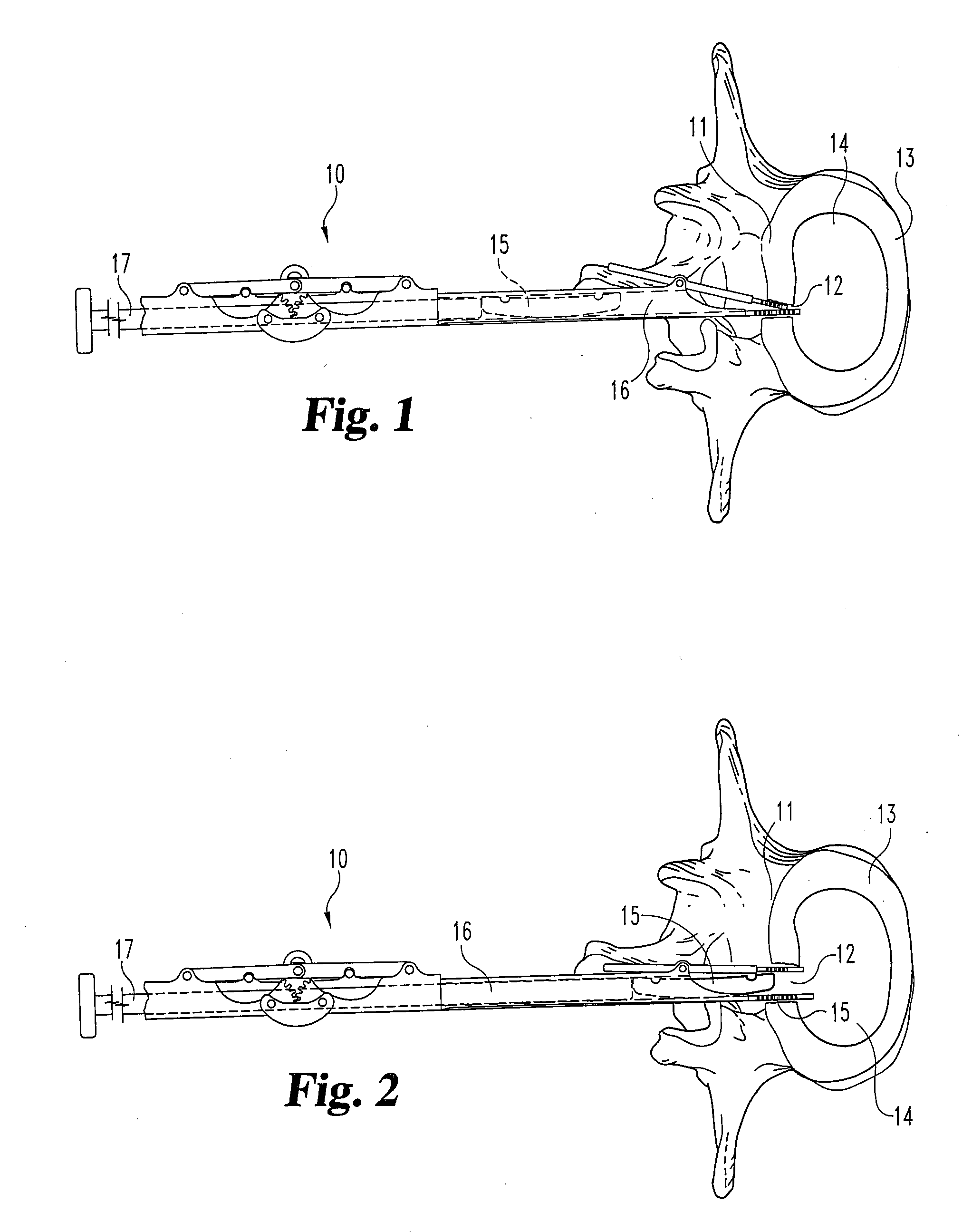Method and apparatus for delivering an intervertebral disc implant