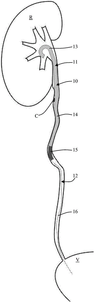 Ureteral stent