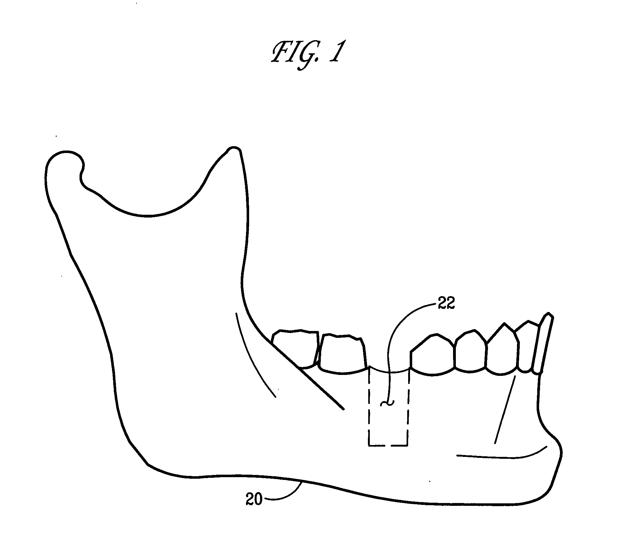 Apparatus and method for using an intraosseous space for moving fluid into and out of the body