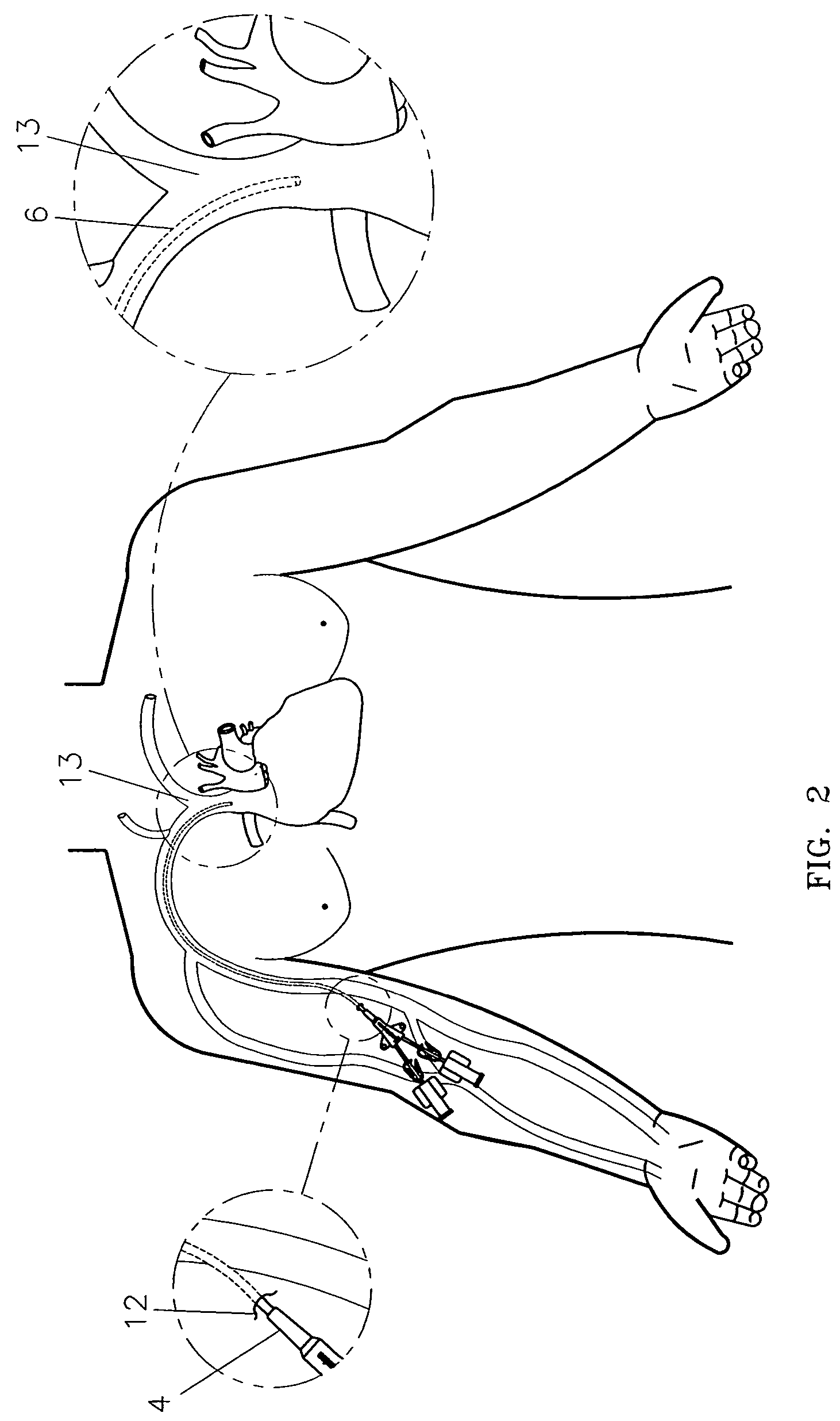 Variable characteristic venous access catheter shaft