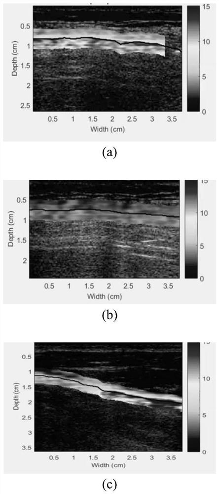 Automatic pneumothorax detection system based on ultrasonic strain imaging