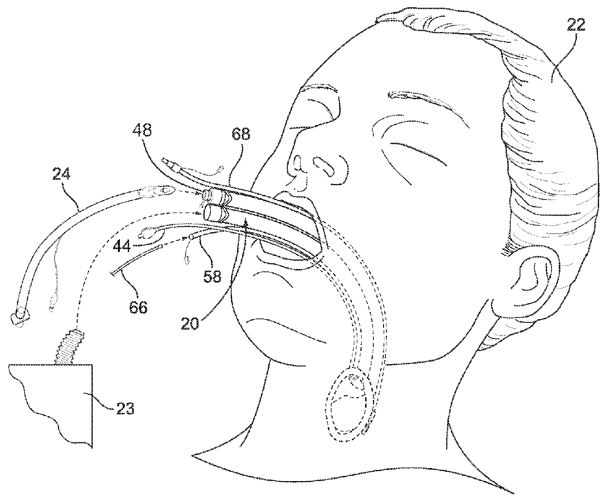 Airway device, airway assist device and the method of using same