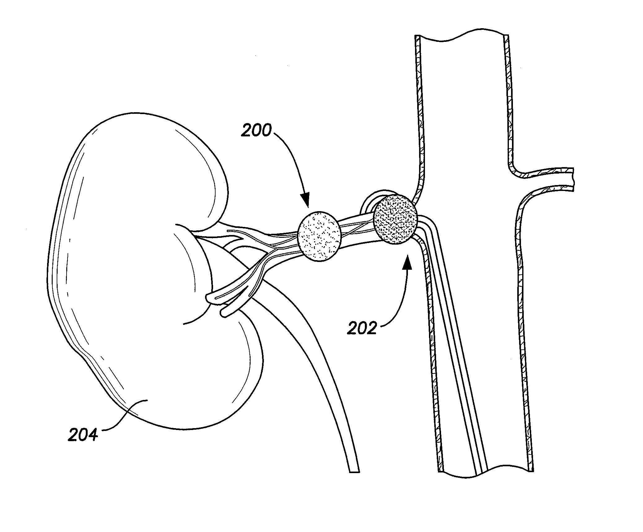 System and method for performing renal denervation verification