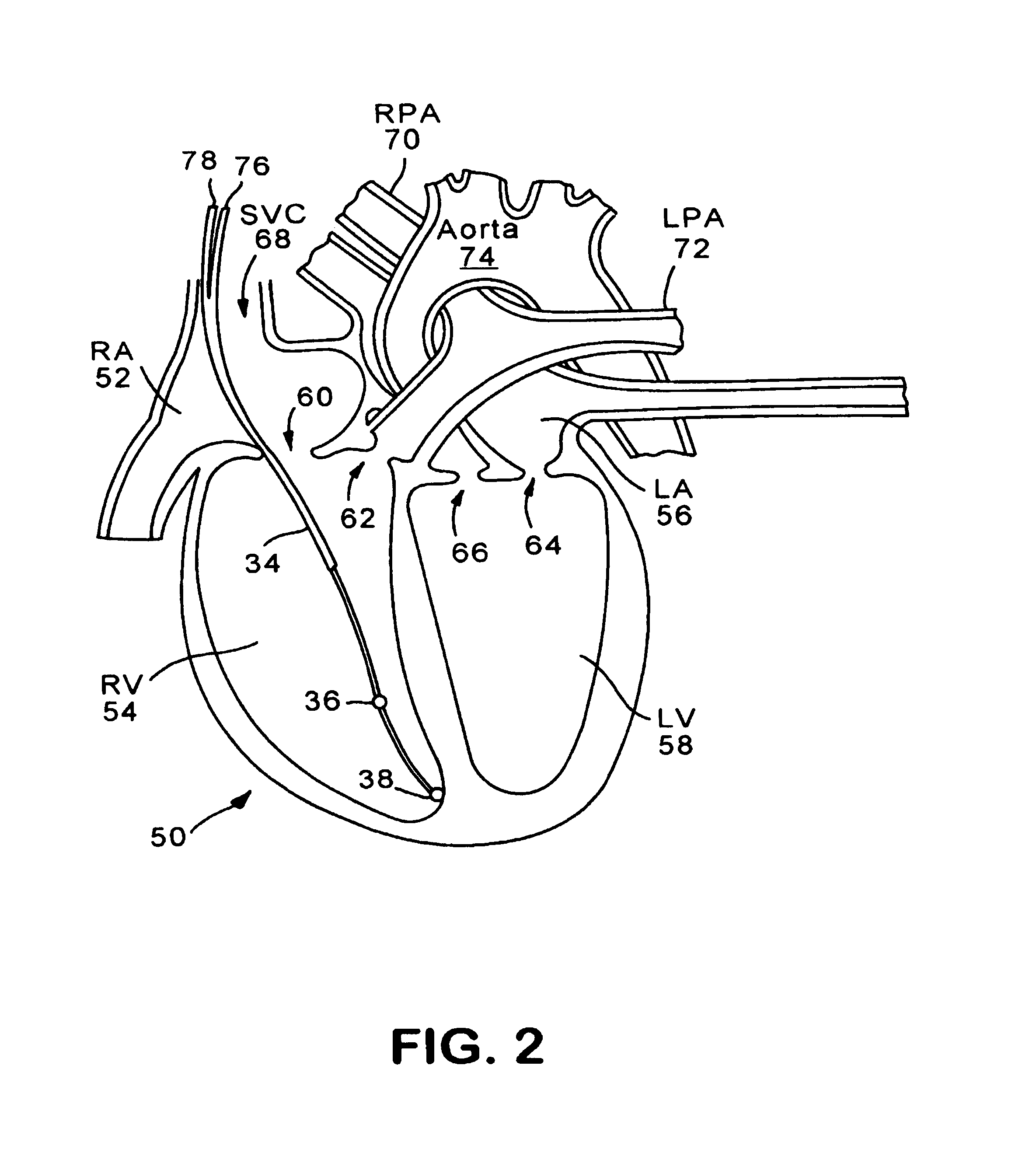 Implantable drug delivery system responsive to intra-cardiac pressure