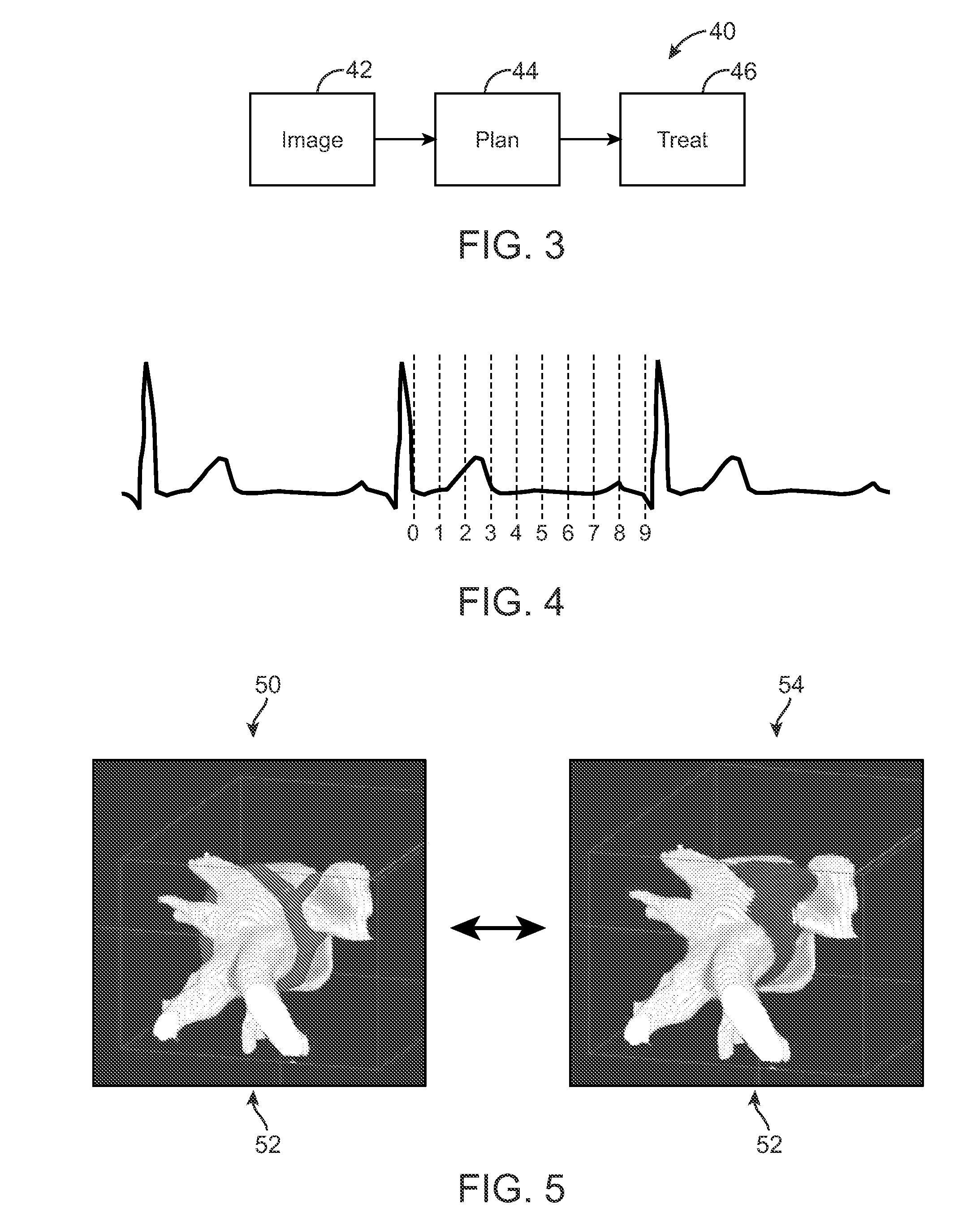 Heart Treatment Kit, System, and Method for Radiosurgically Alleviating Arrhythmia
