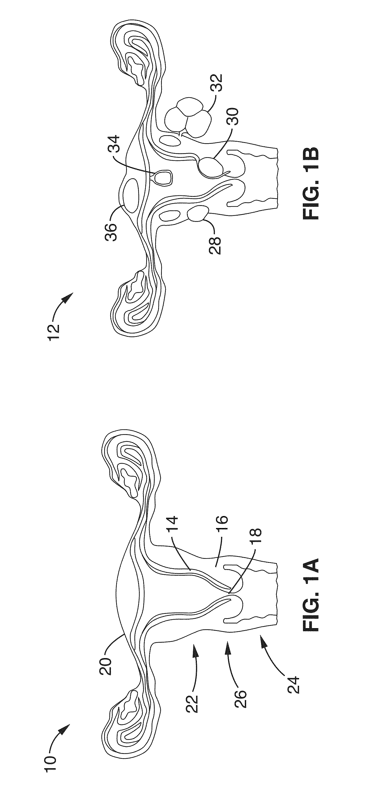 Method of thermal treatment for myolysis and destruction of benign uterine tumors