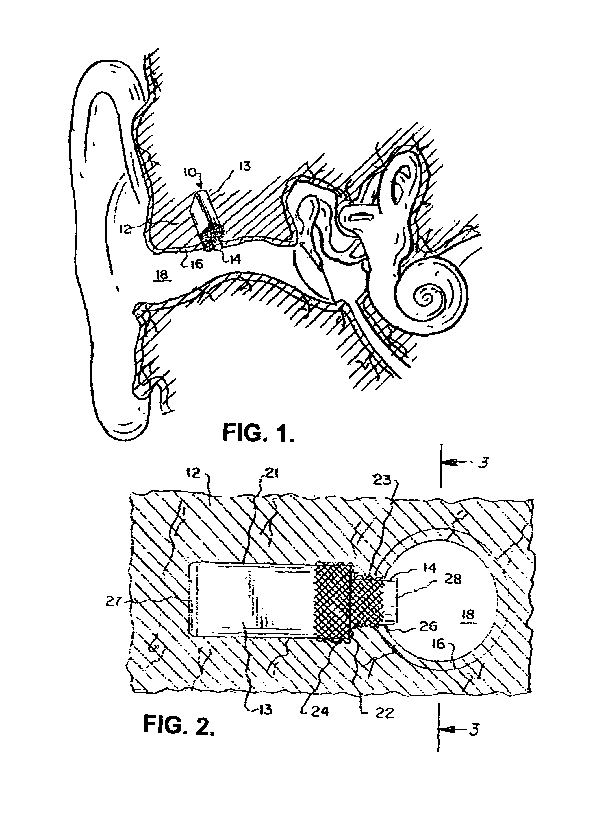 In-the-canal hearing aid using two microphones