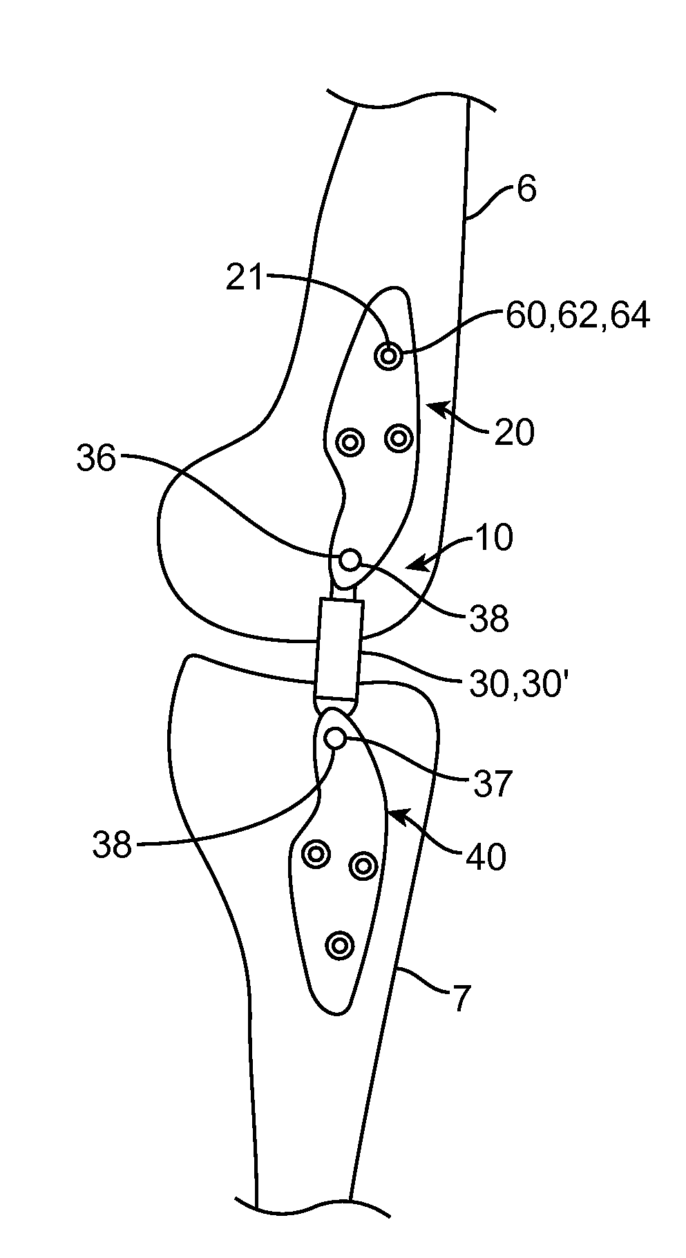 Extra-Articular Implantable Mechanical Energy Absorbing Assemblies and Methods