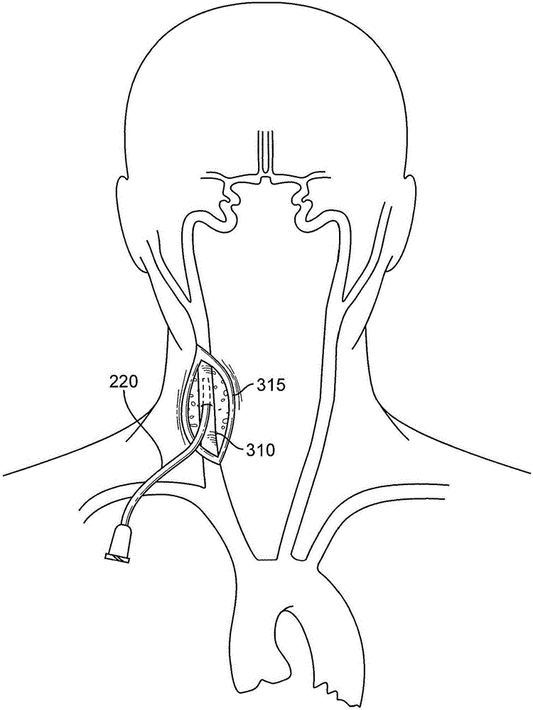 Methods and devices for transcarotid access