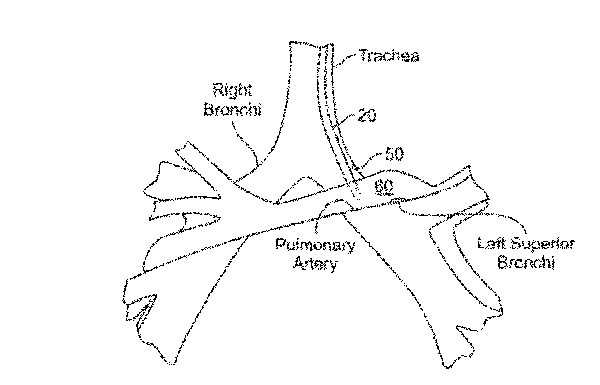 Method and system for measuring pulmonary artery circulation information